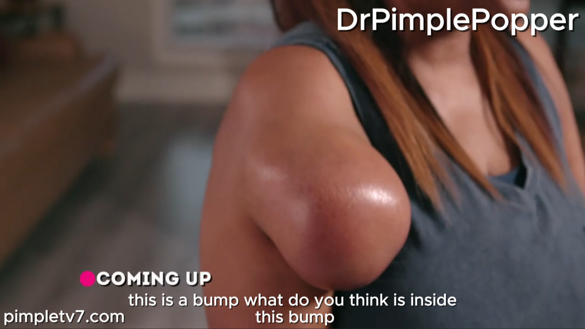 Stacey has a growth on her shoulder that prevents her from being the playful teacher she once was. Dr. Pimple Popper 120826