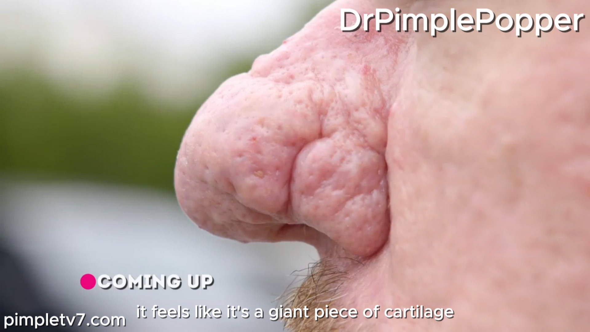 Stephen’s large, bulbous nose gets him unwanted attention, and he hopes Dr. Lee can help. Dr. Pimple Popper 040826