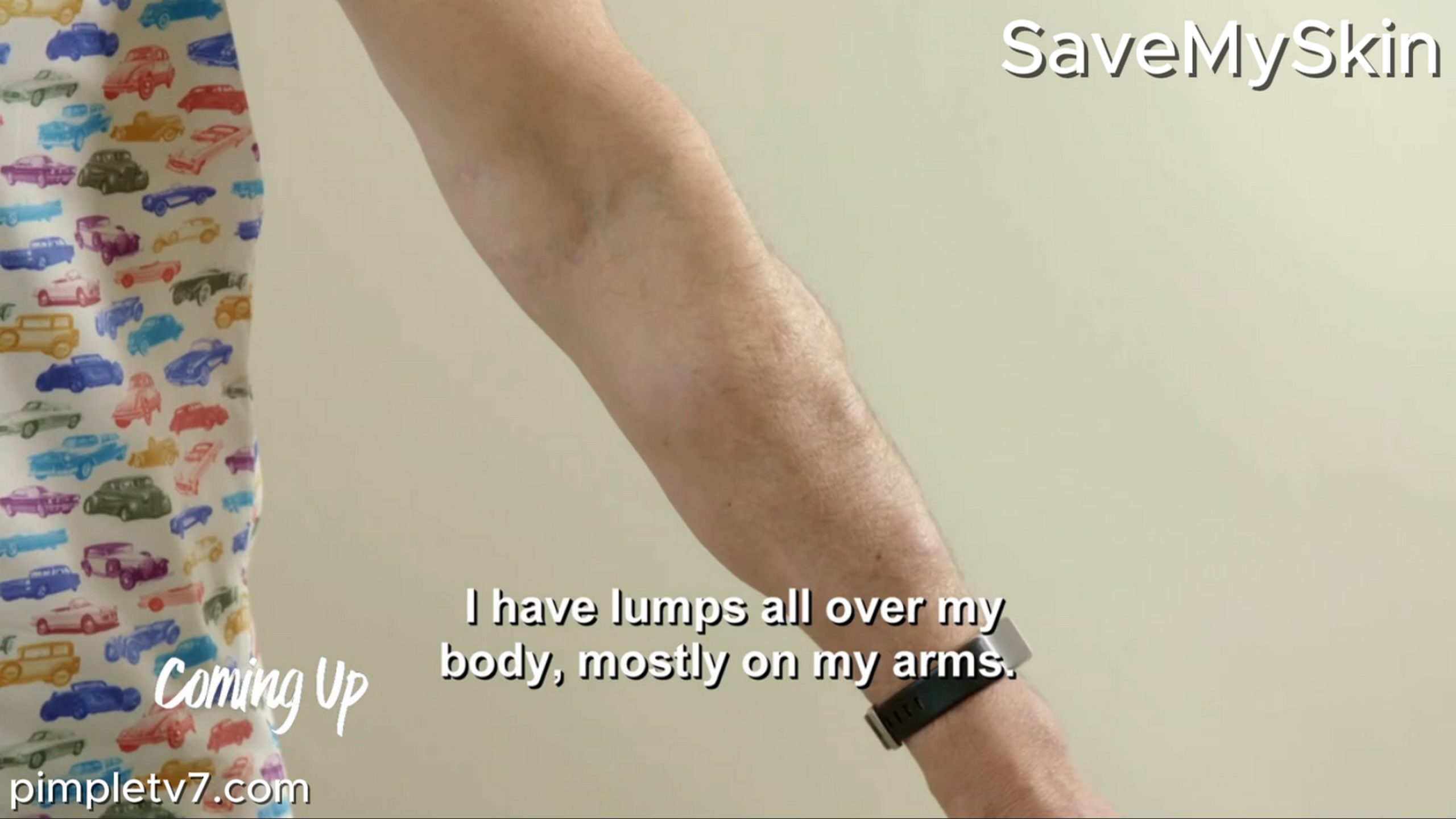 Stephen’s massive number of lumps is often a constant source of pain. SaveMySkin 030826