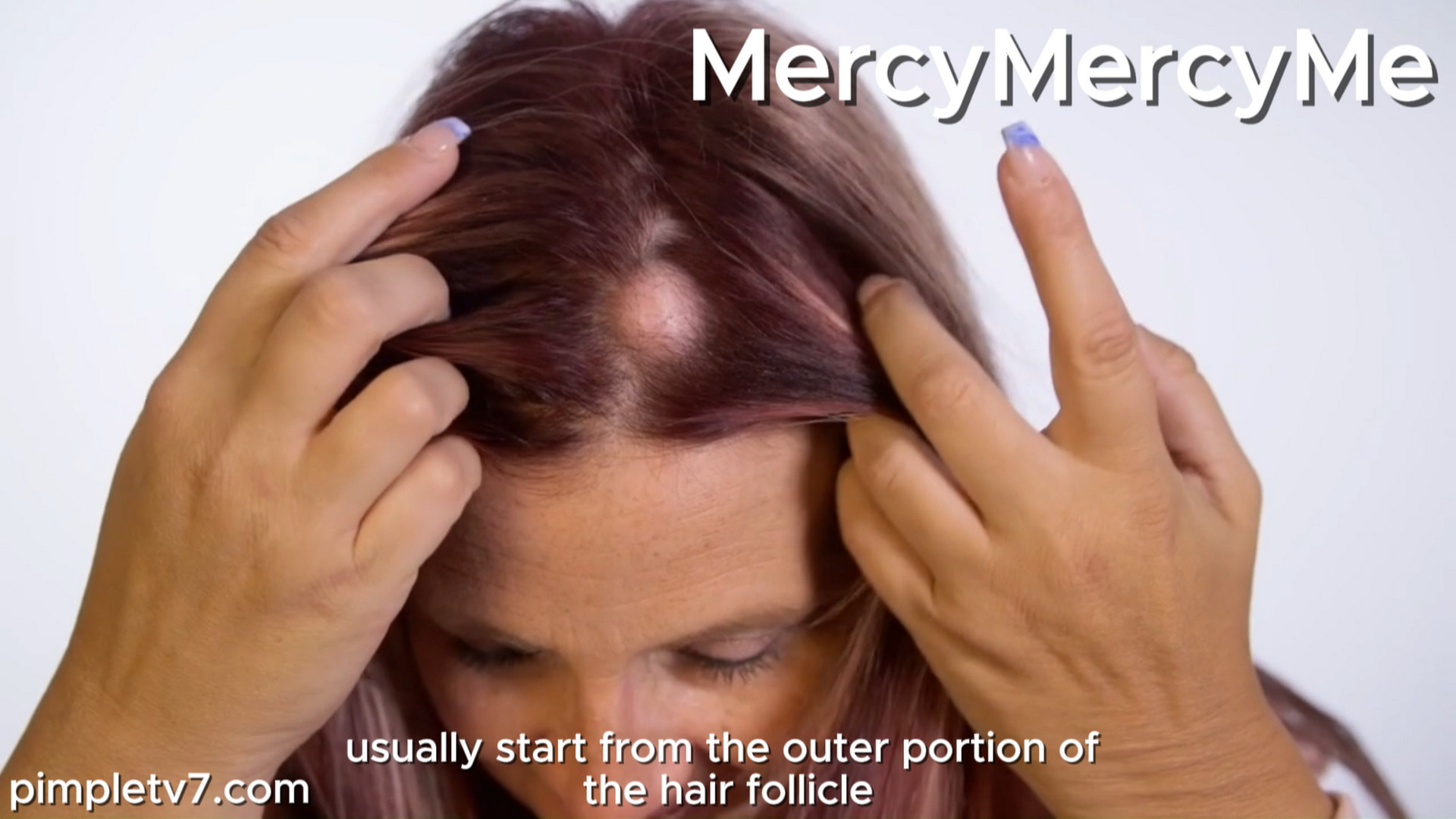 Summer has seven cysts, including one she calls her “unicorn horn.” MercyMercyMe 190826