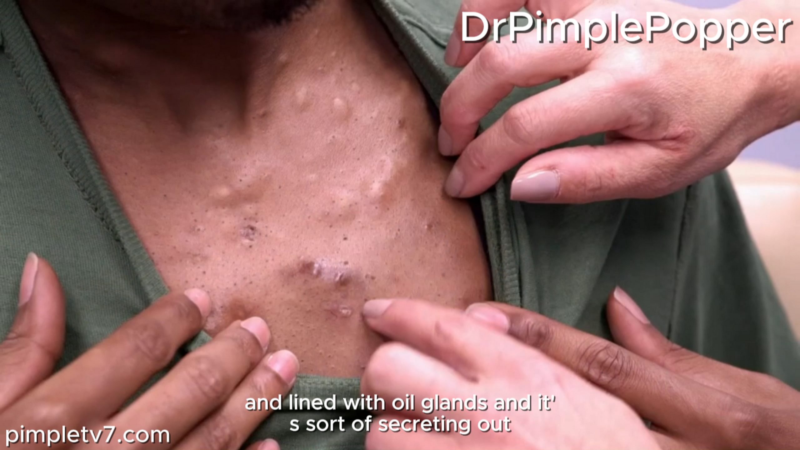 Tahj has basically a bunch of little puffy bumps that turn into big painful boils. Dr. Pimple Popper 240826