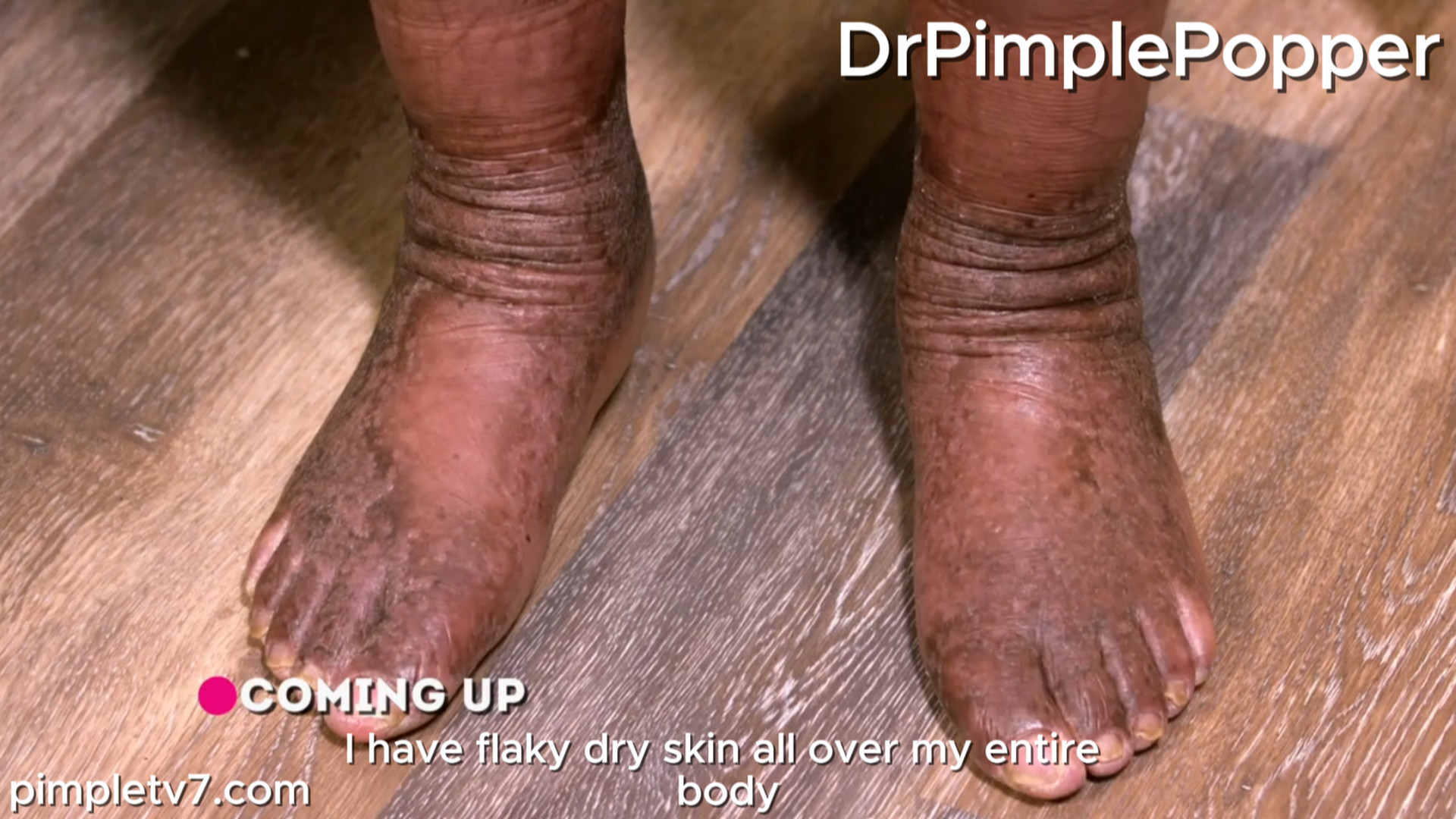 Tamyra has skin so thick that she shaves the bottom of her feet for relief. Dr. Pimple Popper 080826