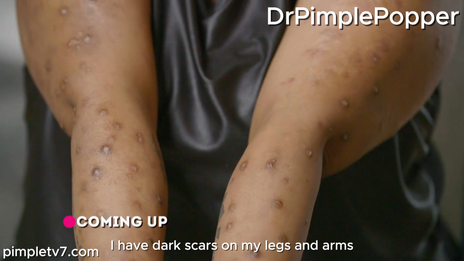 Tanisha has a growth on her arm and itchy scars all over her body. Dr. Pimple Popper 010826