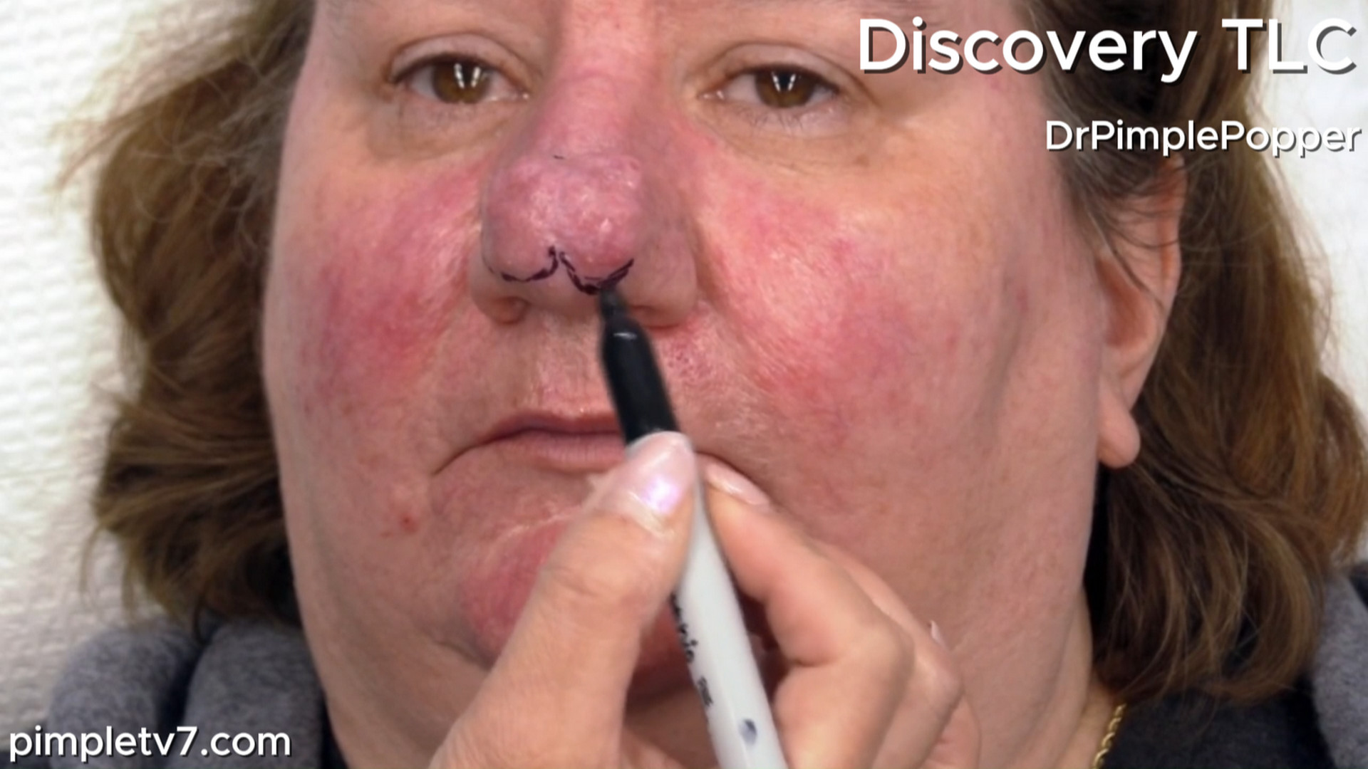 Teresa’s red face and bumpy nose make her feel like a monster. Dr. Pimple Popper 040826