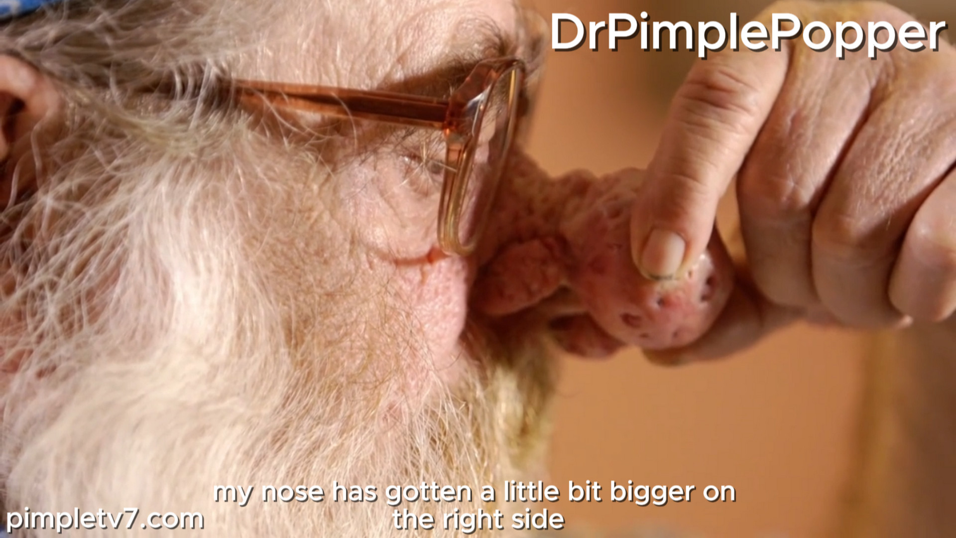 Terry’s nose growth has prevented him from meeting his grandkids. Dr. Pimple Popper 160826