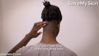 The bumps on Jelani’s head fill with pus. SaveMySkin 040826