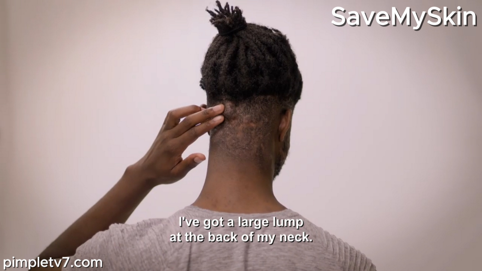 The bumps on Jelani’s head fill with pus. SaveMySkin 040826