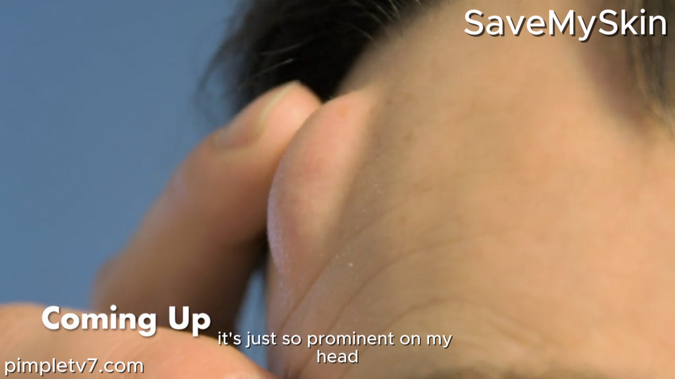 The cyst on Robert’s head has changed him. SaveMySkin 170826