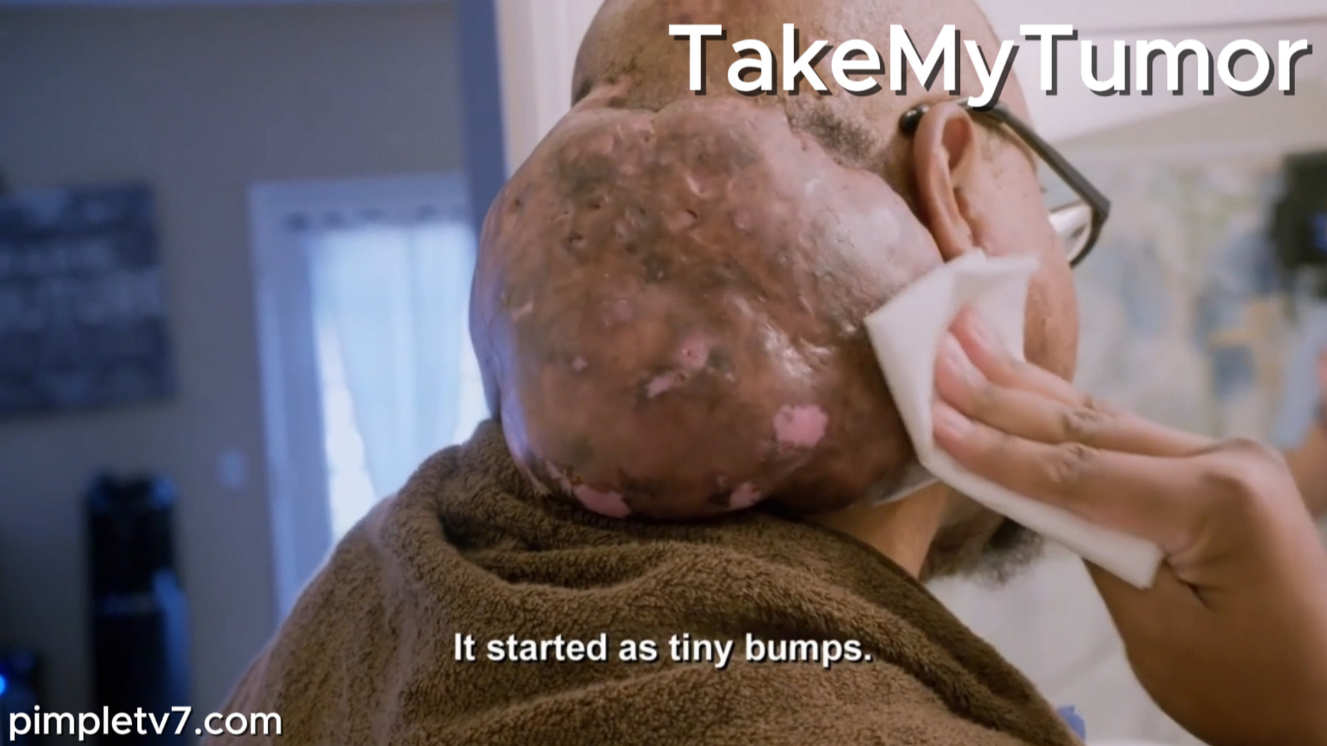 The enormous mass on the back of Arlin’s neck and head constantly oozes fluids, but surgery may prove to be too challenging. TakeMyTumor 210826
