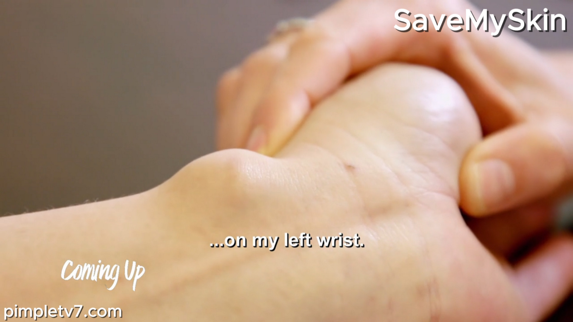 The ganglion cyst on Janette’s wrist is the biggest she has ever seen! SaveMySkin 020826