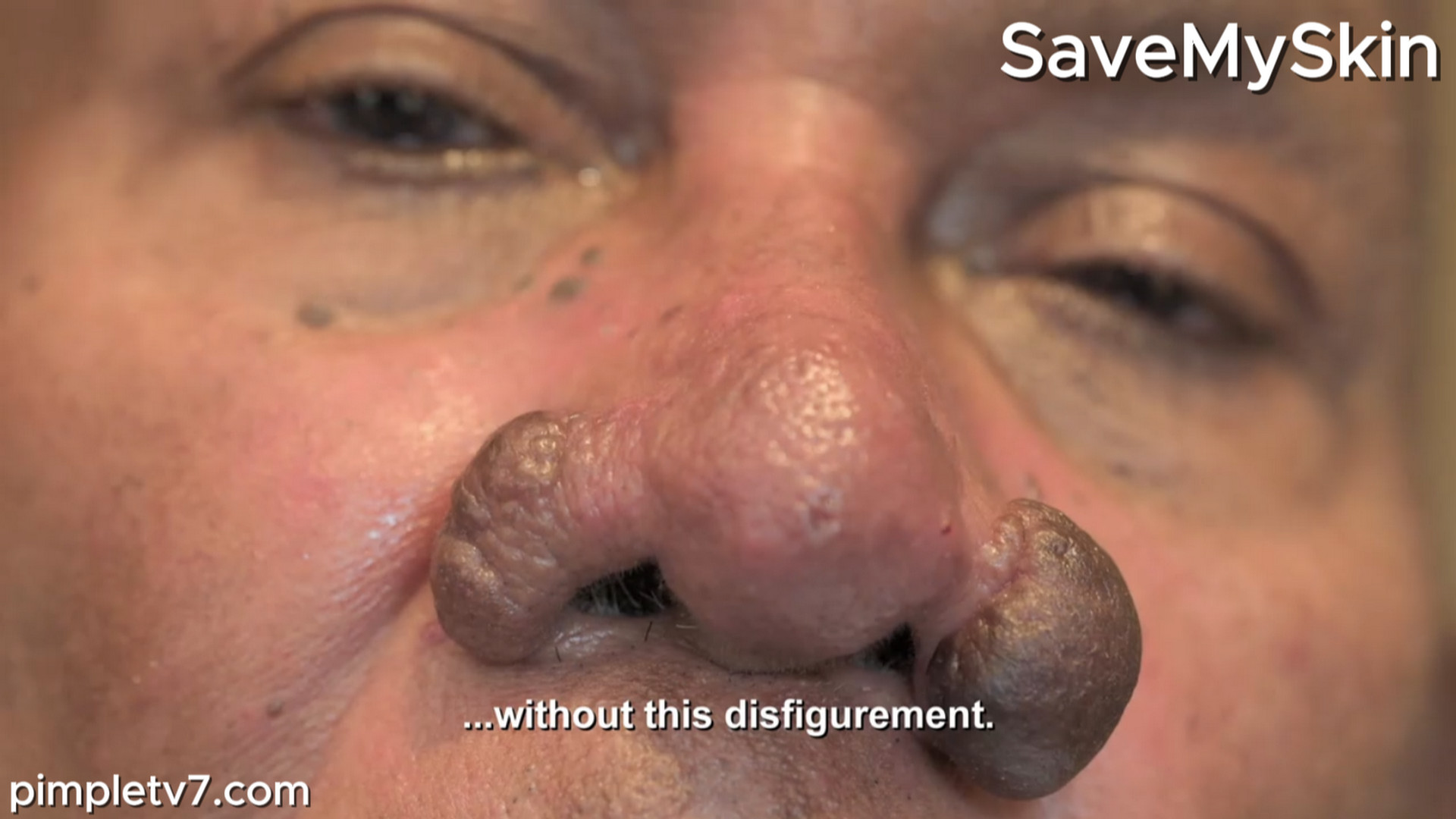 The growths on Krish’s face are very painful. SaveMySkin 010826
