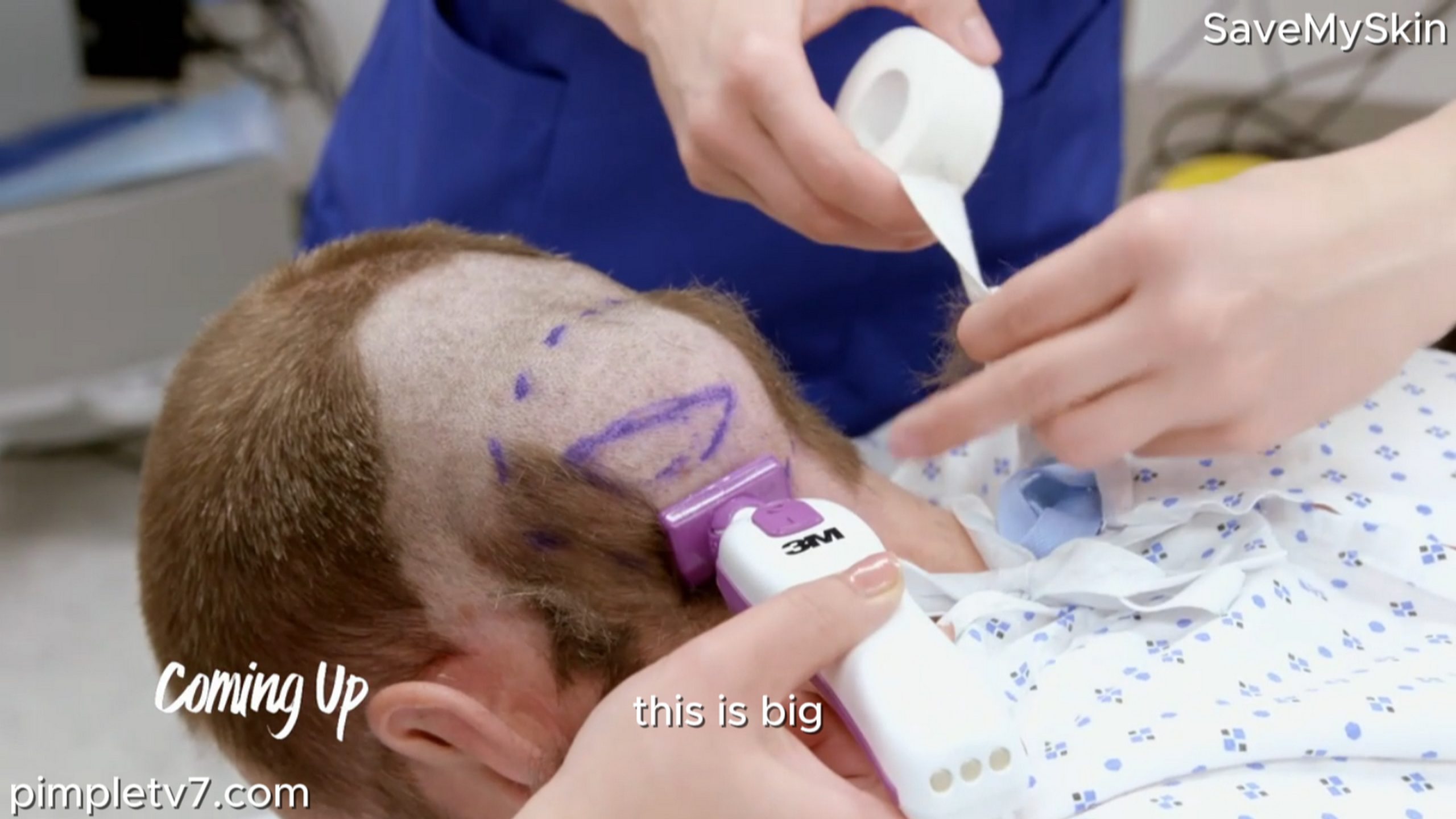 The lump on Gary’s head has him worried for his health. SaveMySkin 050826