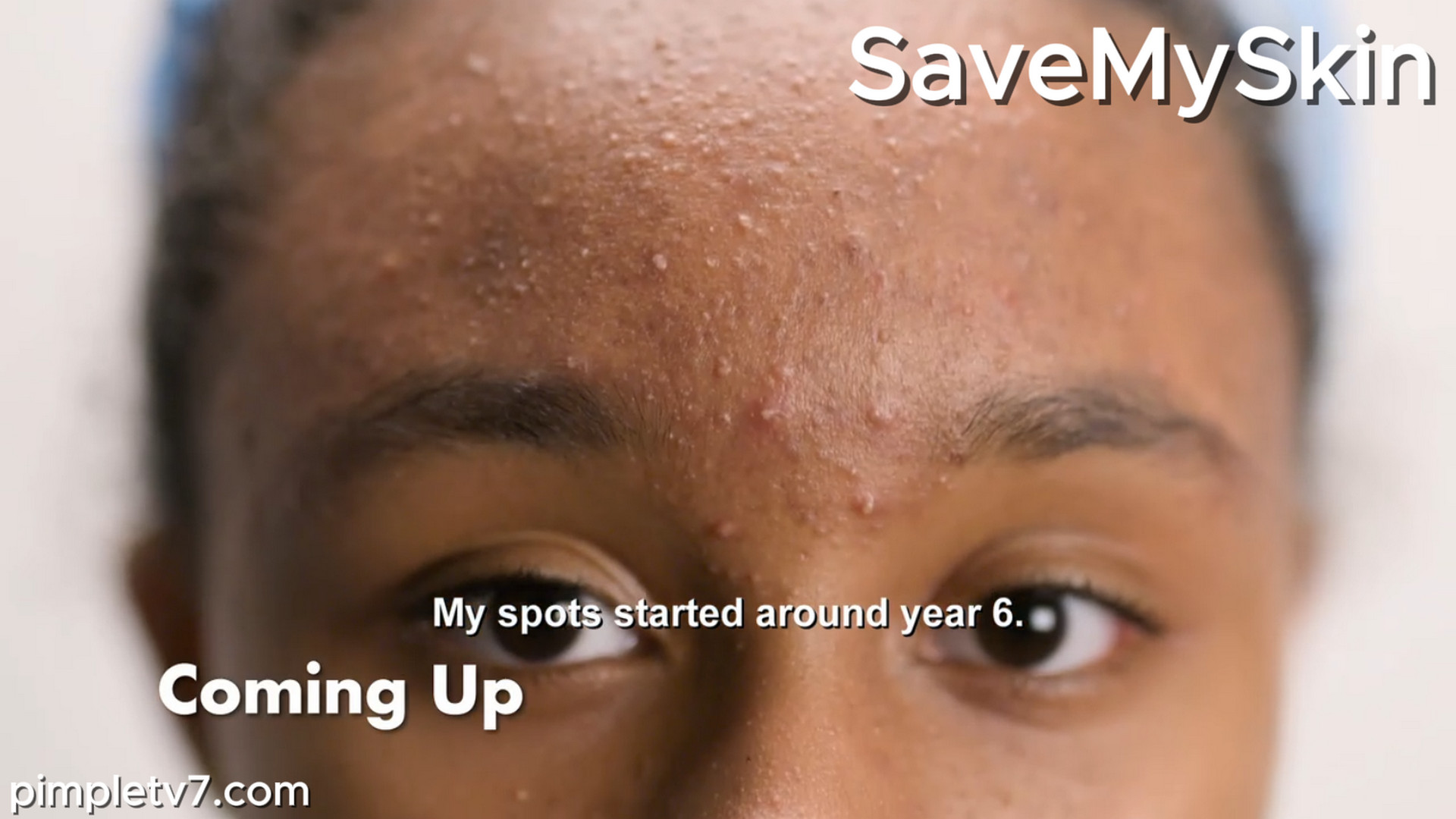 Thirteen-year-old Genevieve has a bad case of acne. SaveMySkin 250826