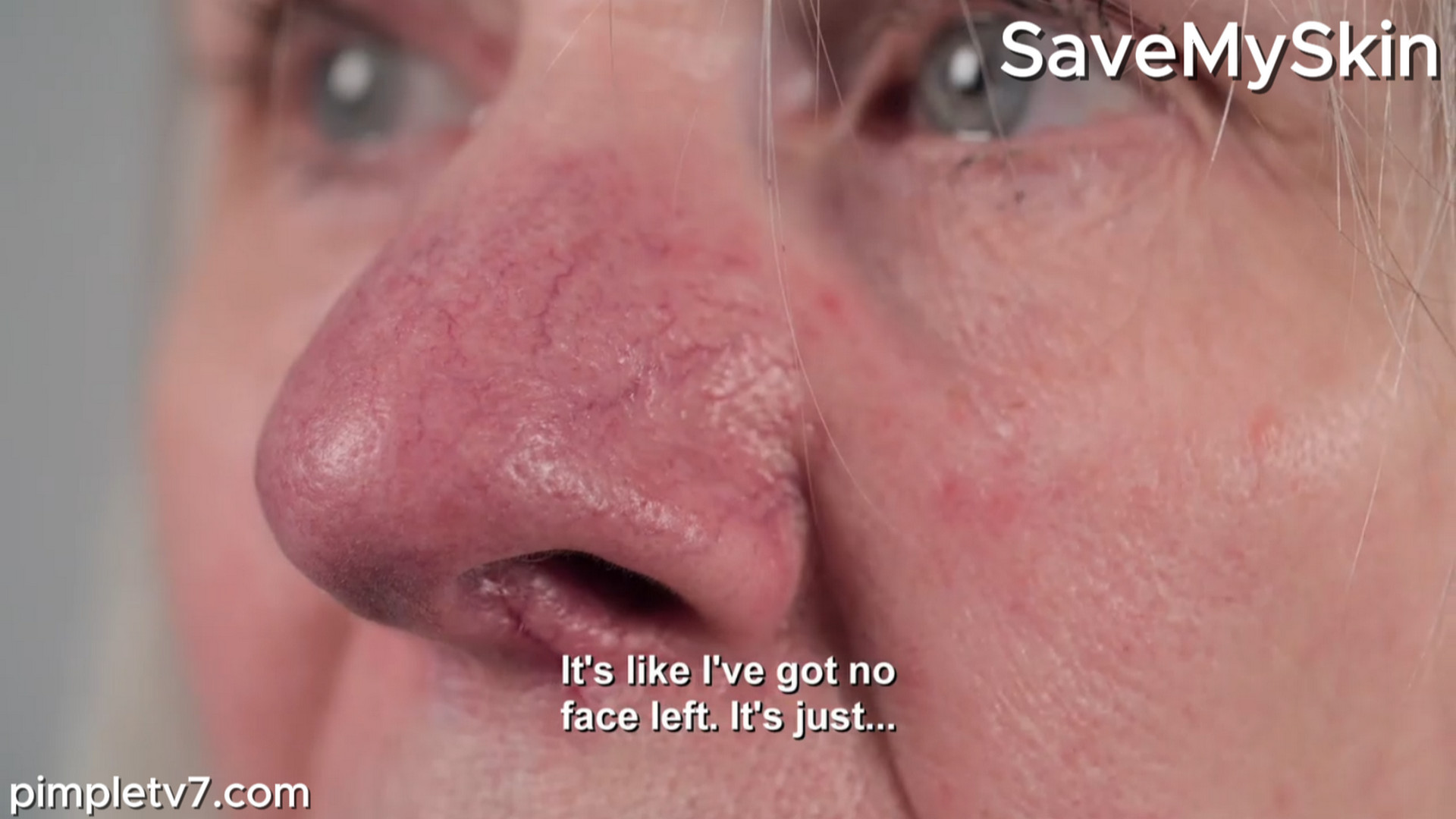 Trish’s nose is changing shape day by day. SaveMySkin 310726