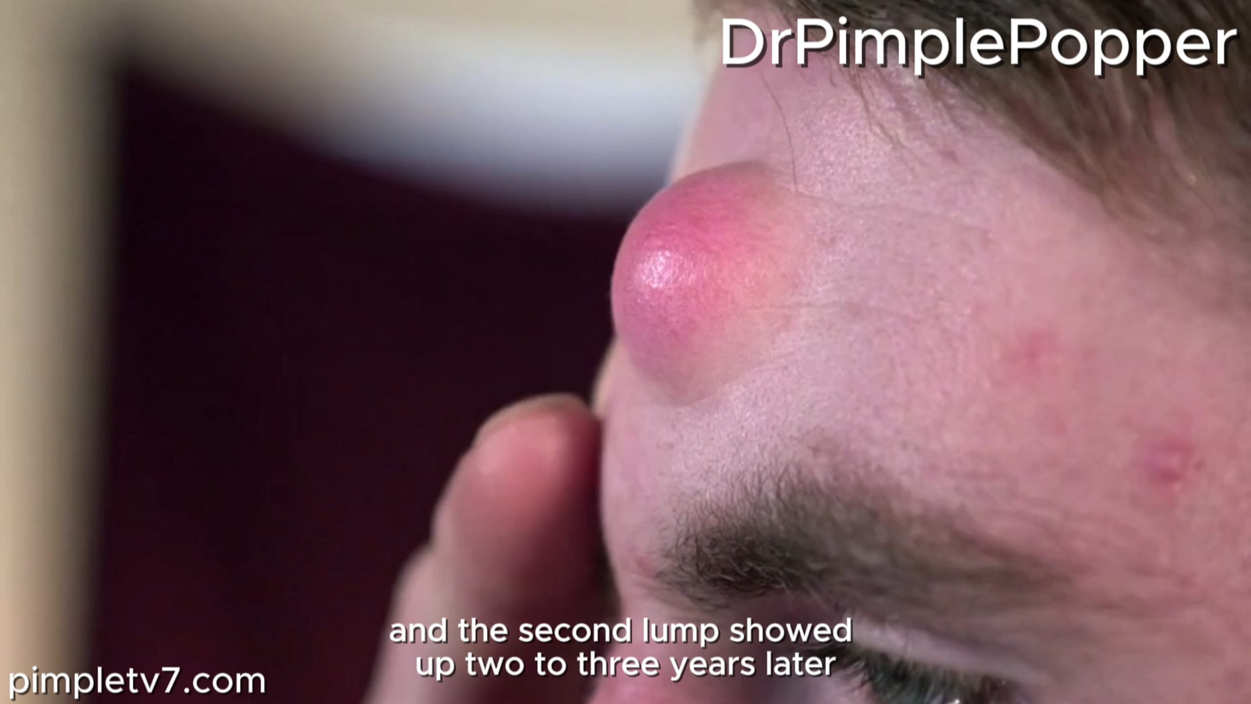 Tyler’s fear of cancer has kept him from having his head lumps diagnosed. Dr. Pimple Popper 250826