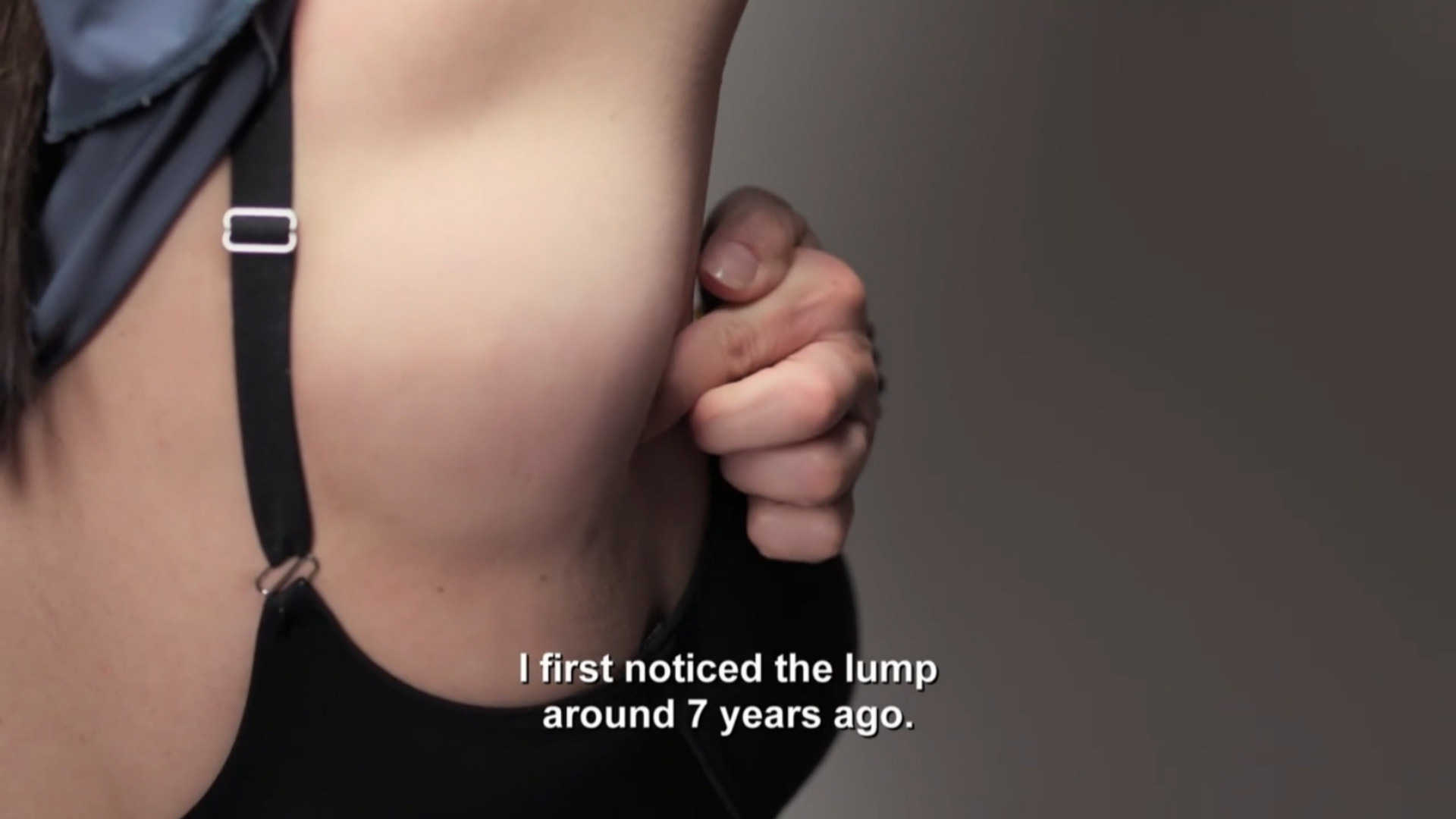 Vicki’s lipoma makes her self-conscious during her DJ performances. SaveMySkin 270826