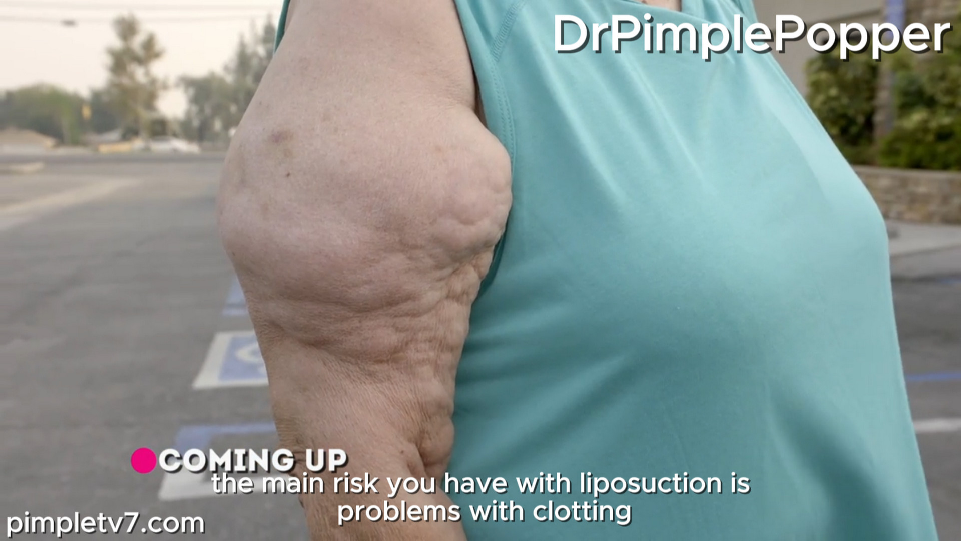 Virginia has large growths on both of her upper arms that make it difficult to travel in her RV. Dr. Pimple Popper 100826