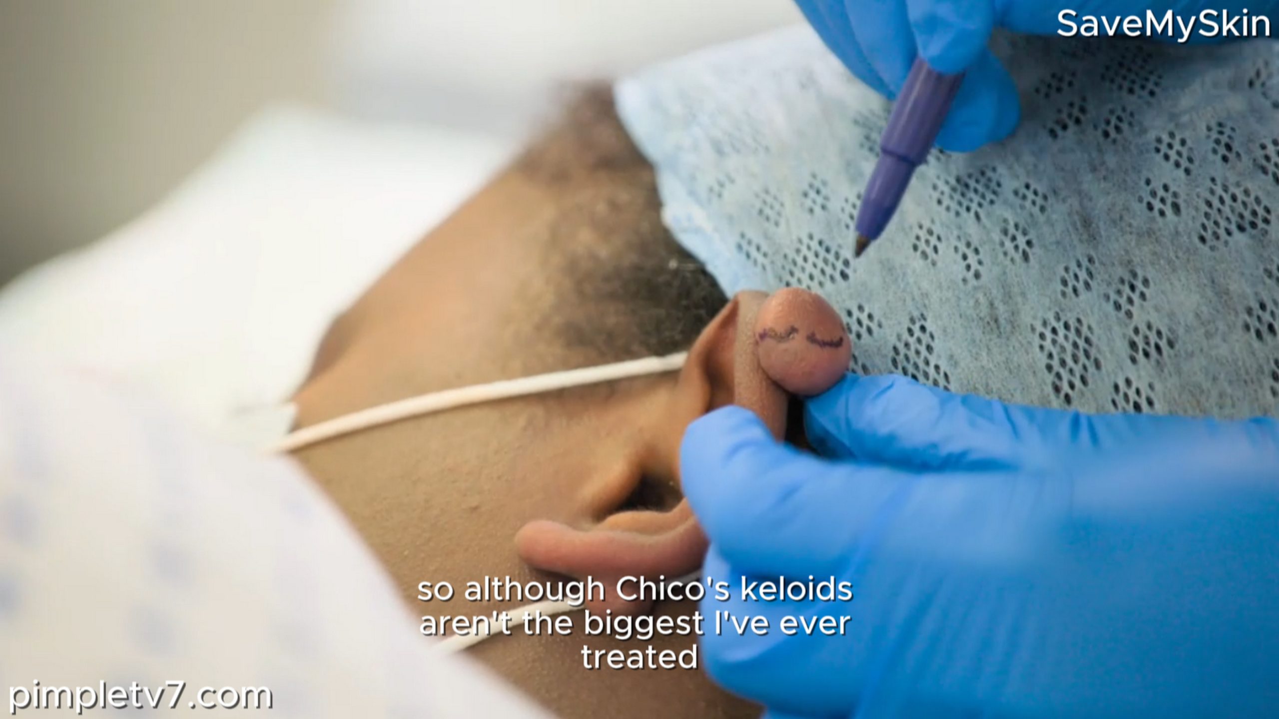 Zviko is ready to say goodbye to her ear keloids. SaveMySkin 090826