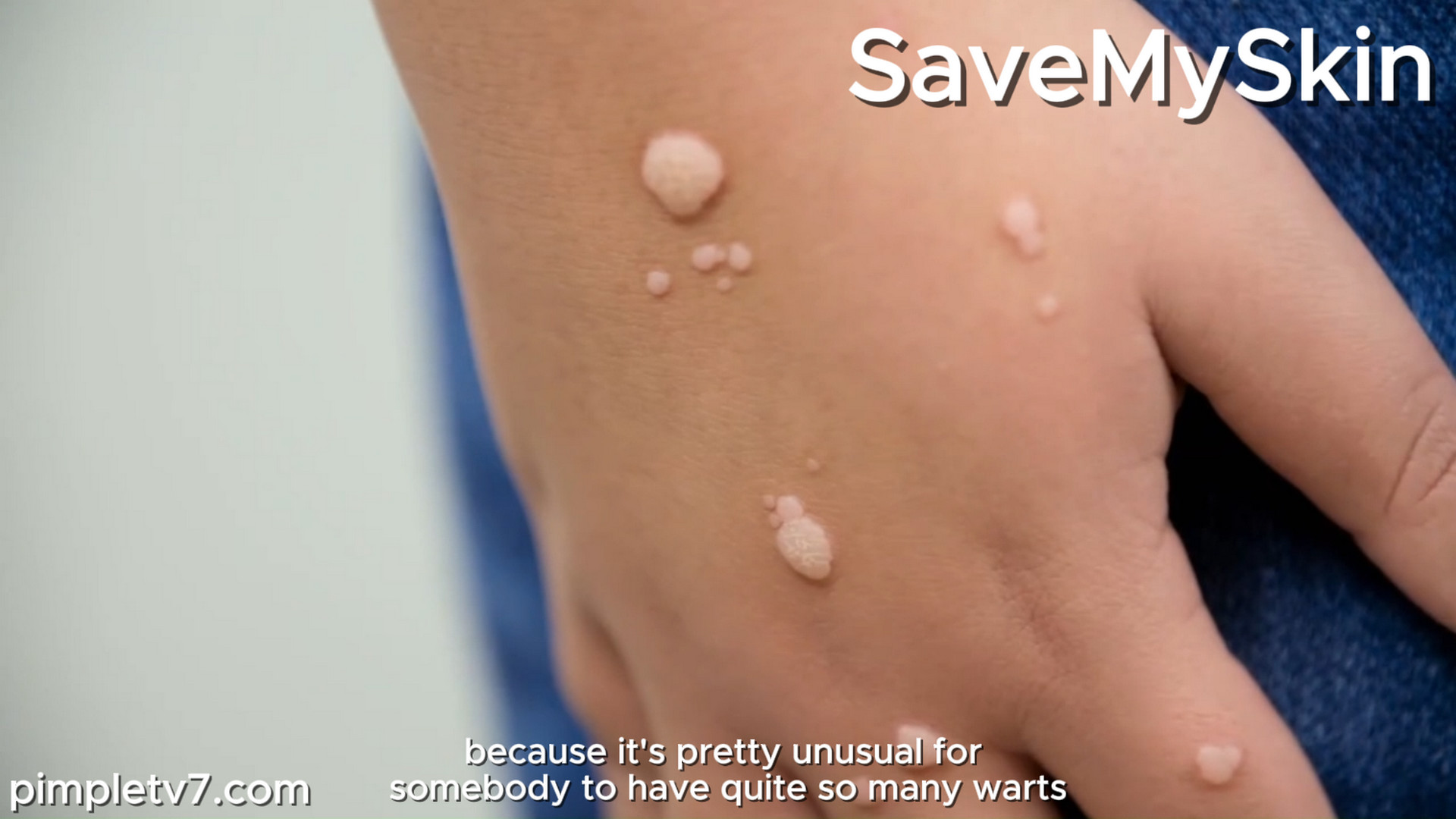 10-year-old Lily has over 40 warts on her hands. SaveMySkin 170926
