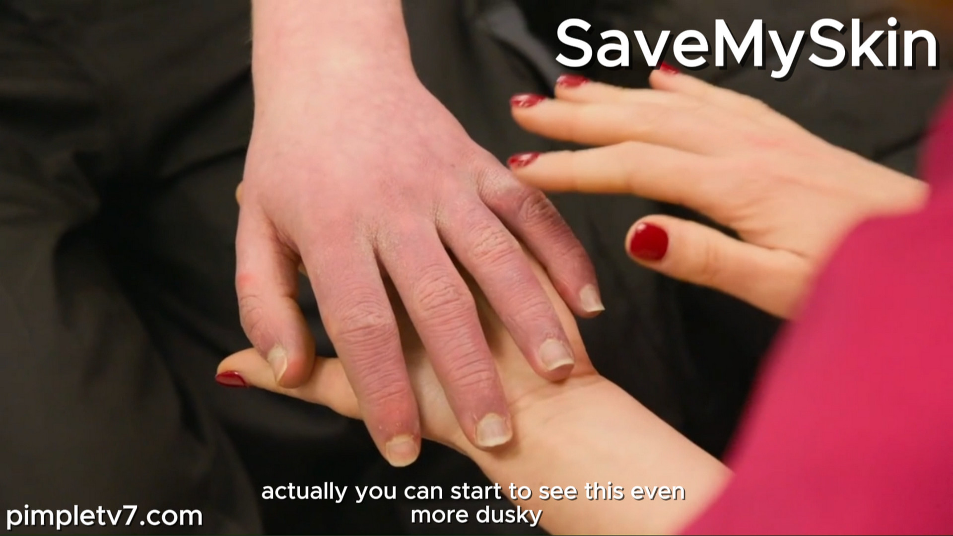19-year-old Sean is desperate for help with a rare and excruciatingly painful condition. SaveMySkin 180926