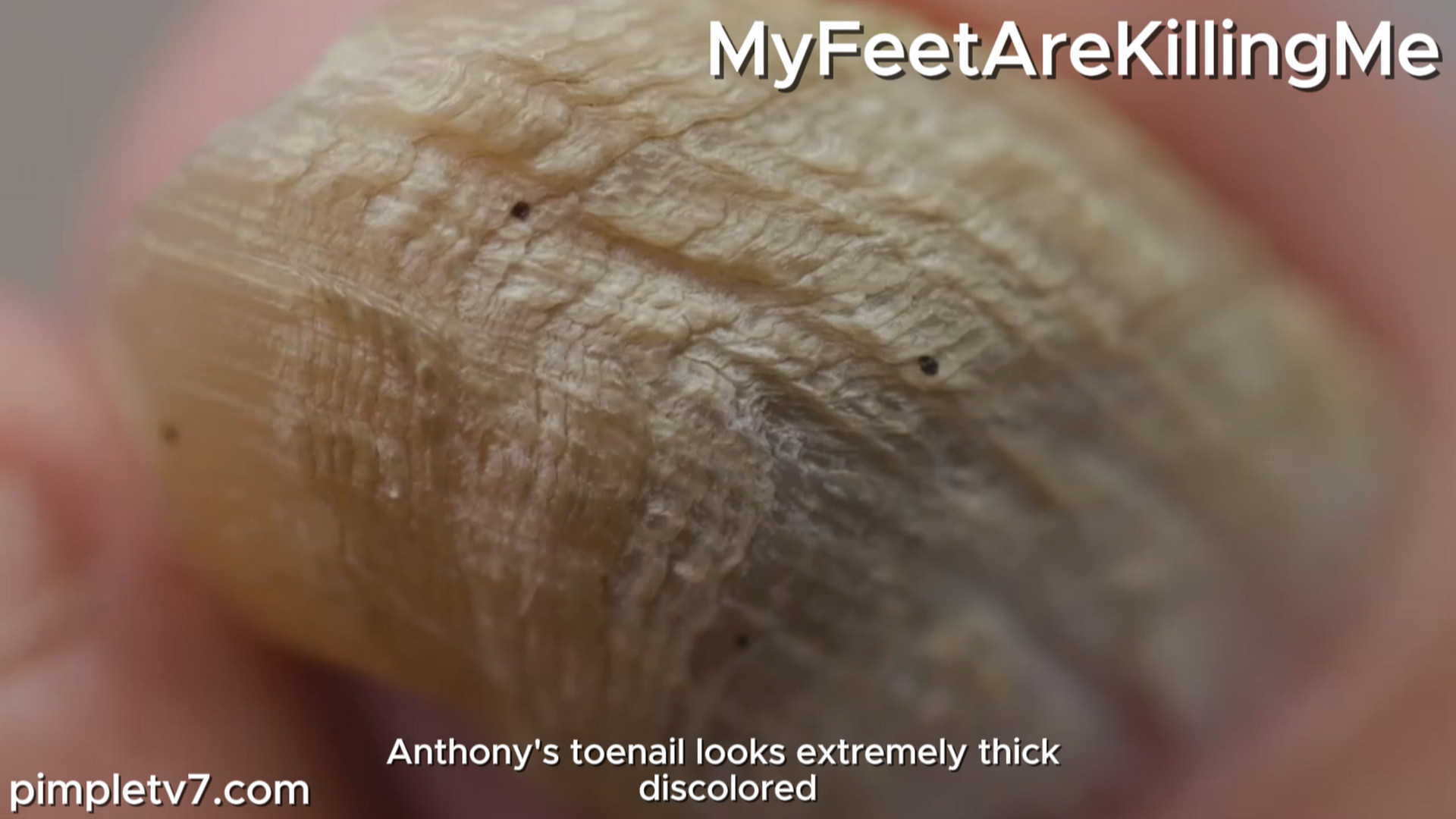 A barber that dropped a steel door on his big toe 20 years ago whose nail has now grown. MyFeetAreKillingMe 220926