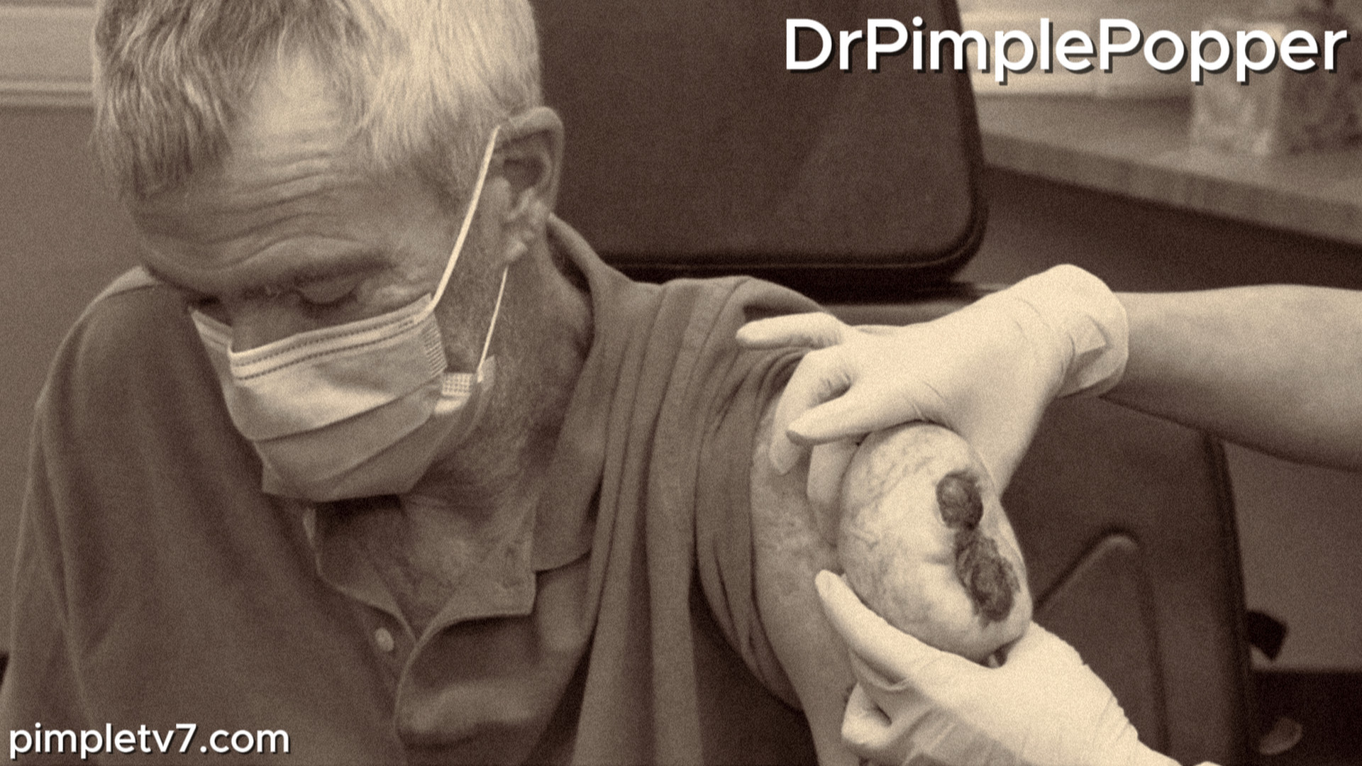 A man has a bump hanging off of his arm that looks like it’s breaking through the skin. Dr. Pimple Popper 240926