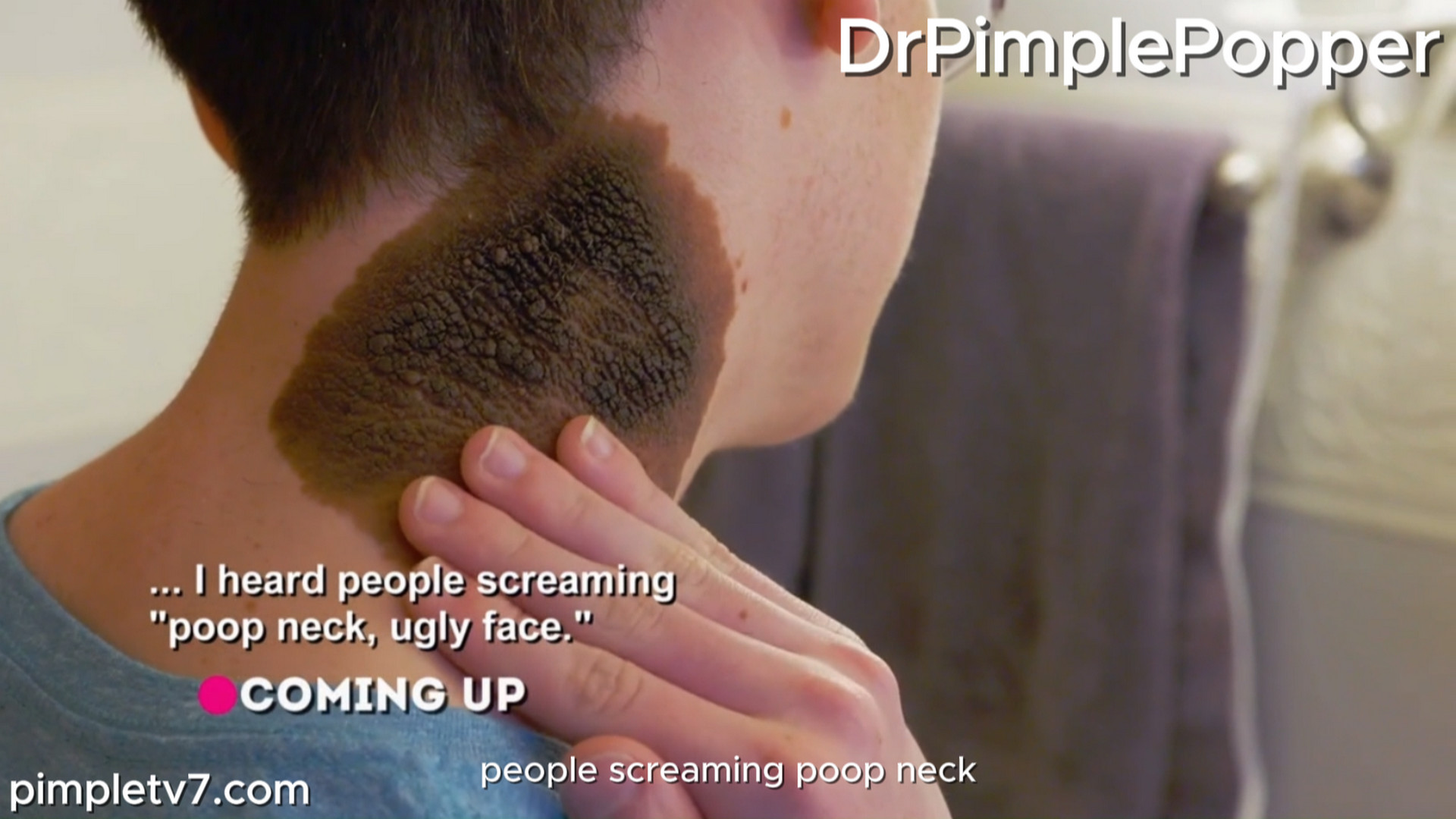 A man has a large, embarrassing birthmark on his neck. Dr. Pimple Popper 300926