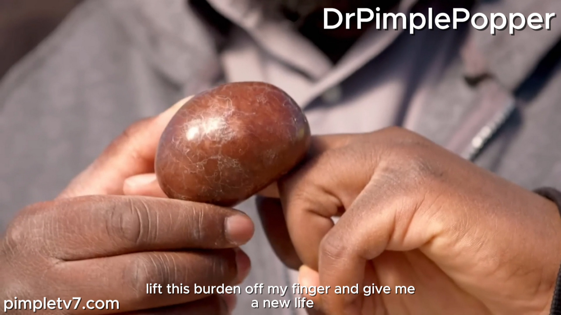 A man has a mysterious, kiwi-size lump on his middle finger. Dr. Pimple Popper 290926