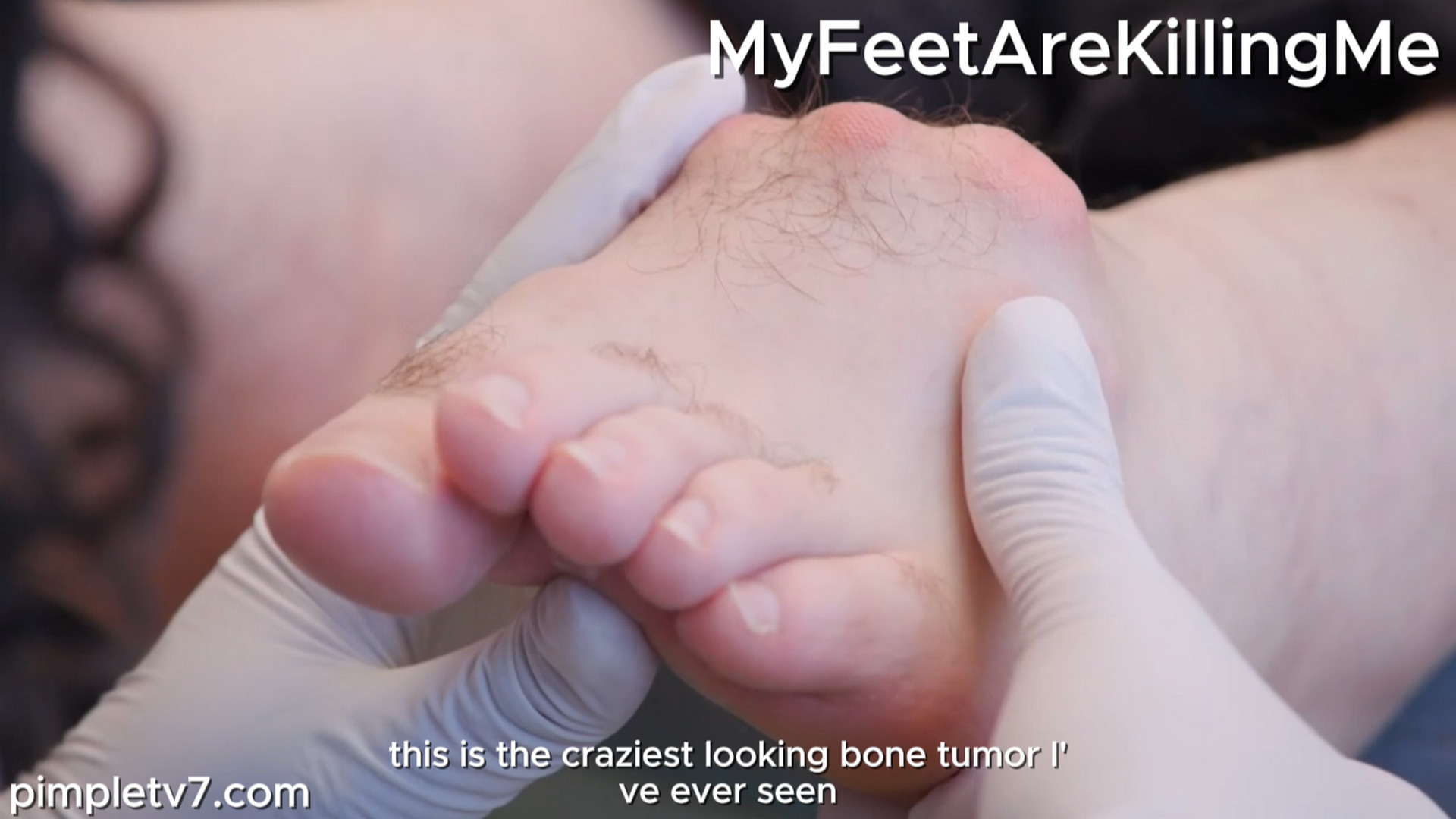 A man with a mysterious hard growth on his foot. MyFeetAreKillingMe 240926