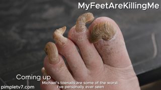 A man with pasta-shaped toenails. MyFeetAreKillingMe 110926