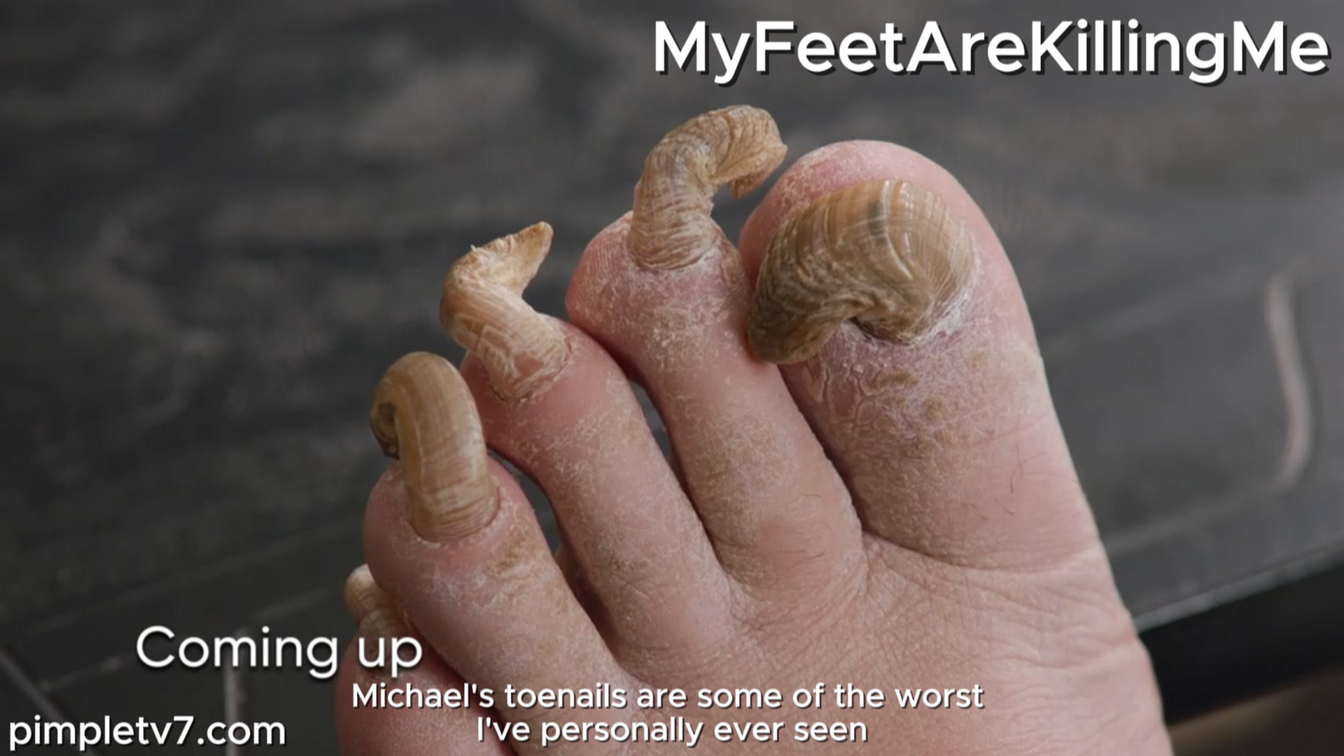 A man with pasta-shaped toenails. MyFeetAreKillingMe 110926