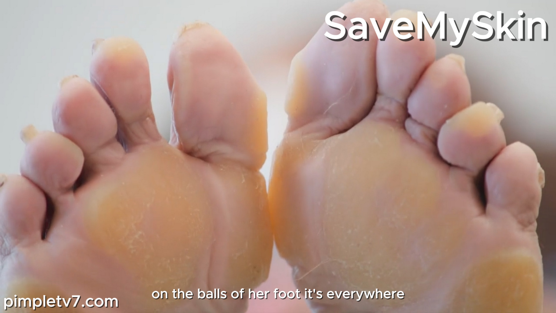 A mother with extreme calluses all have the doctors battling major cases. MyFeetAreKillingMe 160926