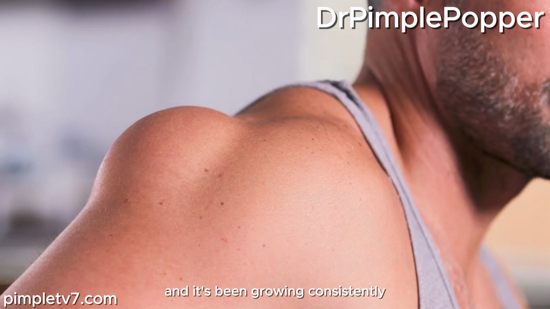 A patient has a bump on his shoulder, and his daughters fear it’s dangerous. Dr. Pimple Popper 230926