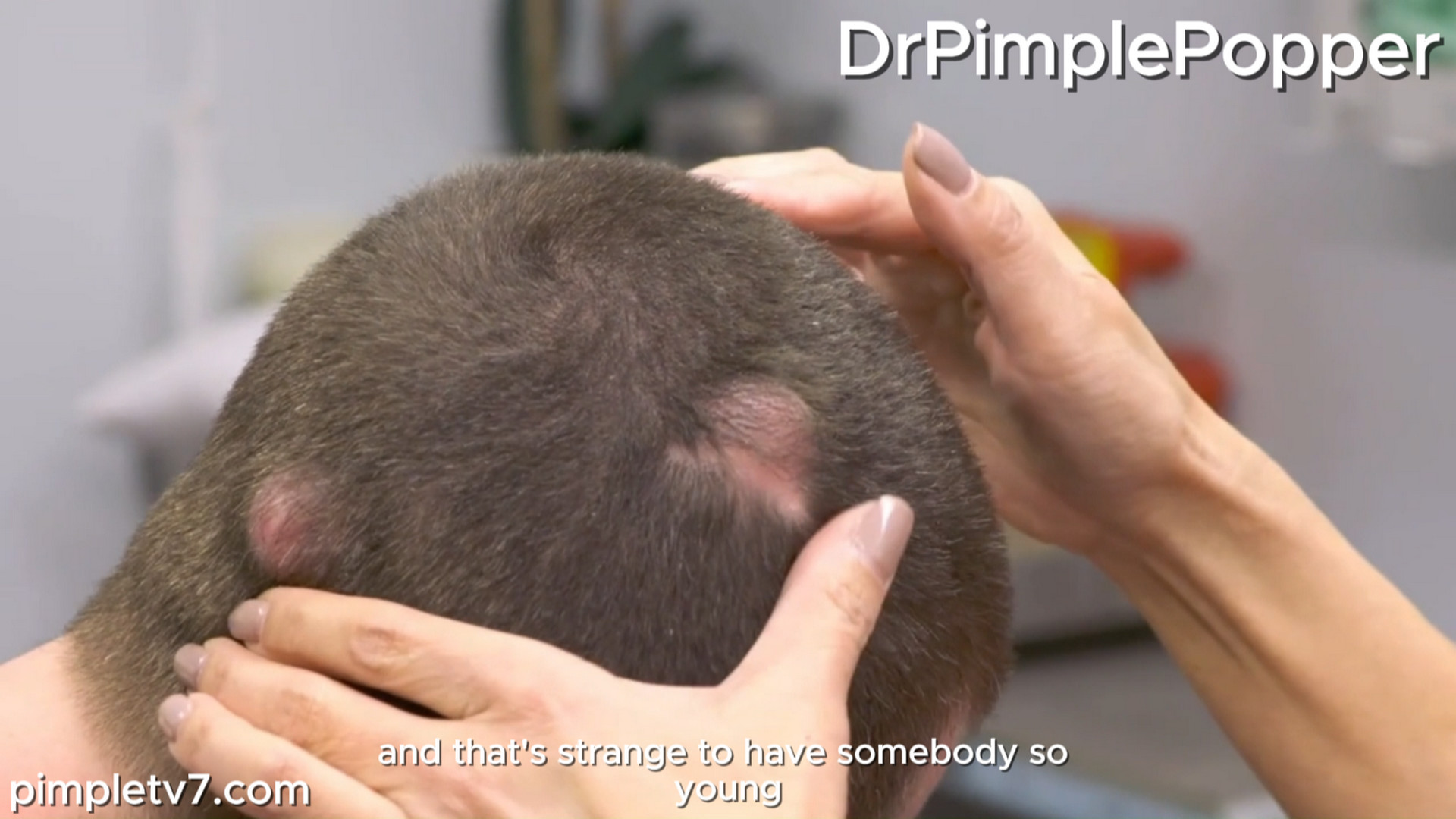 A patient has several lumps on his head that make him fear for his life. Dr. Pimple Popper 240926