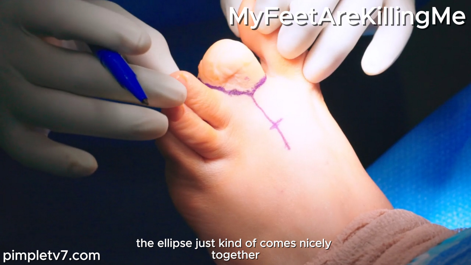 A woman born with a massively large toe is desperate for Dr. Ebonie’s help. MyFeetAreKillingMe 160926