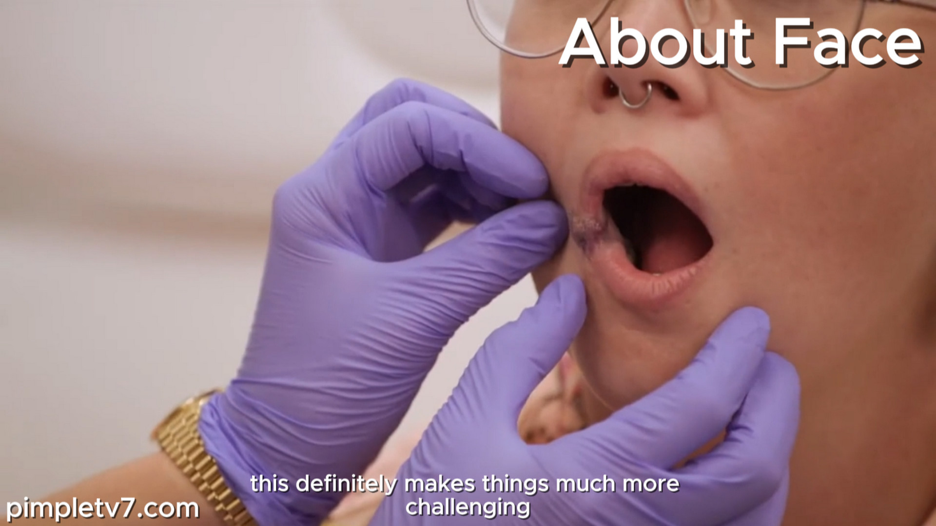 A woman hopes Dr. Rovelo can remove her mouthy birthmark. AboutFace 210926