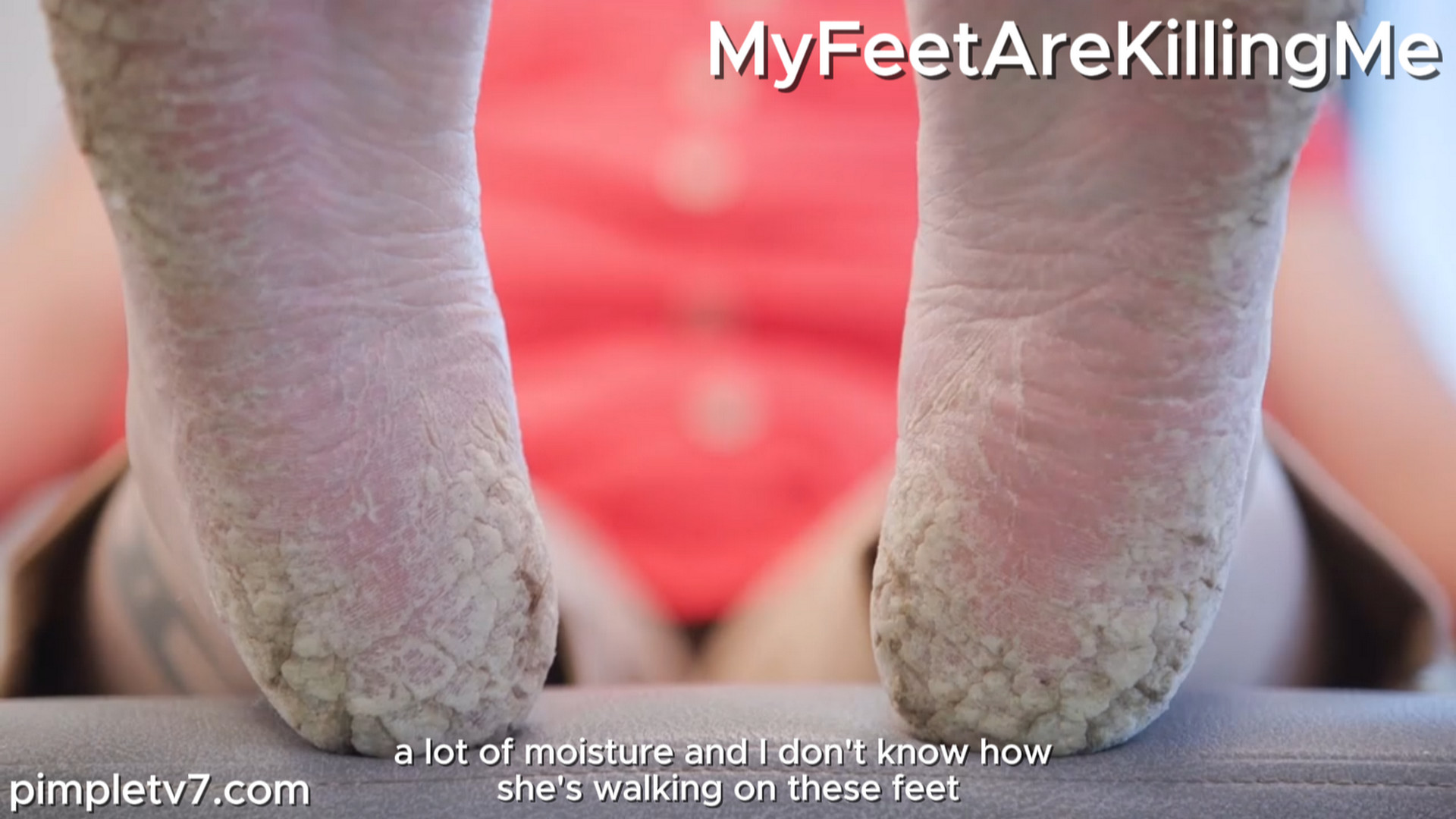 A woman with feet that look like stones. MyFeetAreKillingMe 200926