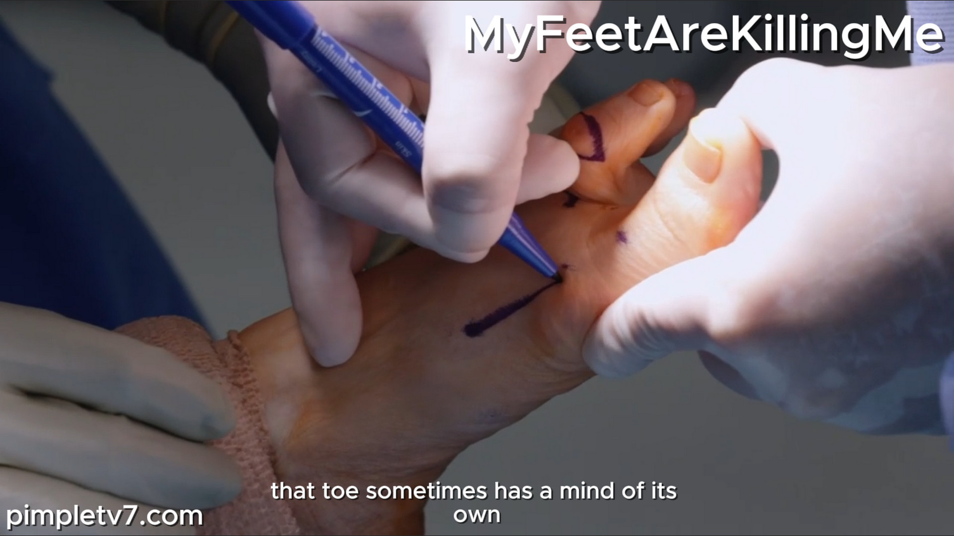 A woman with twisted toes. MyFeetAreKillingMe 150926