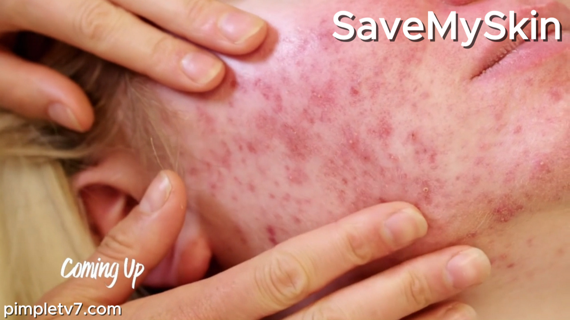 Abigail’s acne has run unchecked for years. SaveMySkin 080926