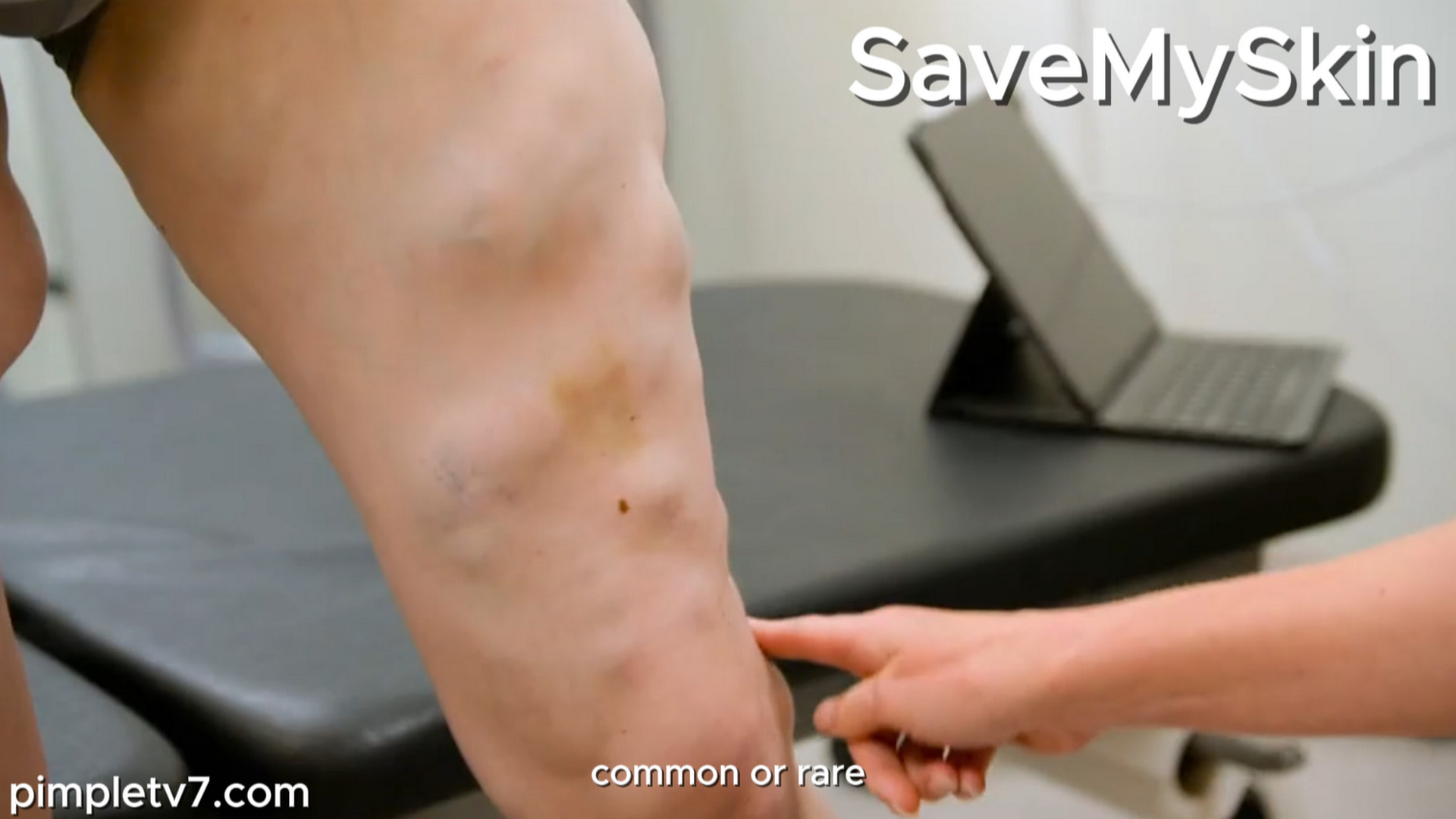 Adam hopes to get a diagnosis for over 60 lumps covering his body. SaveMySkin 260926