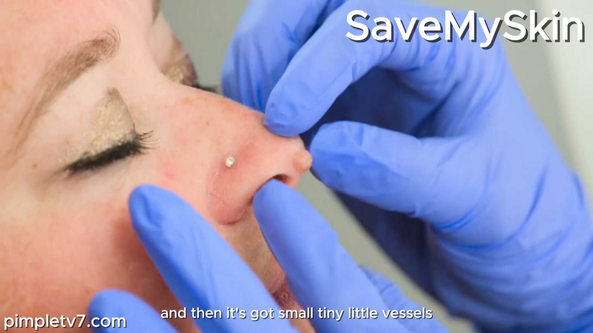 After years of horrible comments, Kayley finally gets a diagnosis about whether the growth on the end of her nose is a wart. SaveMySkin 240926