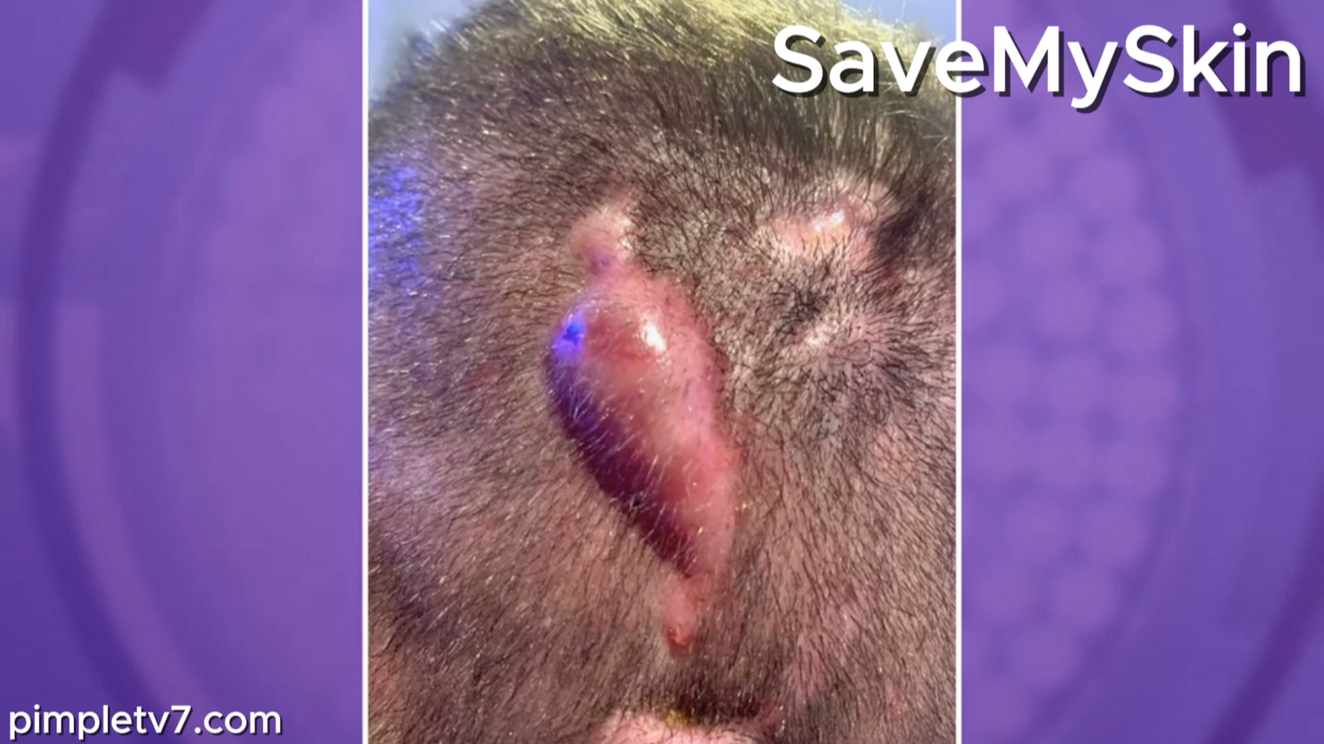 Alex wants the lumps on the back of his head removed. SaveMySkin 310826
