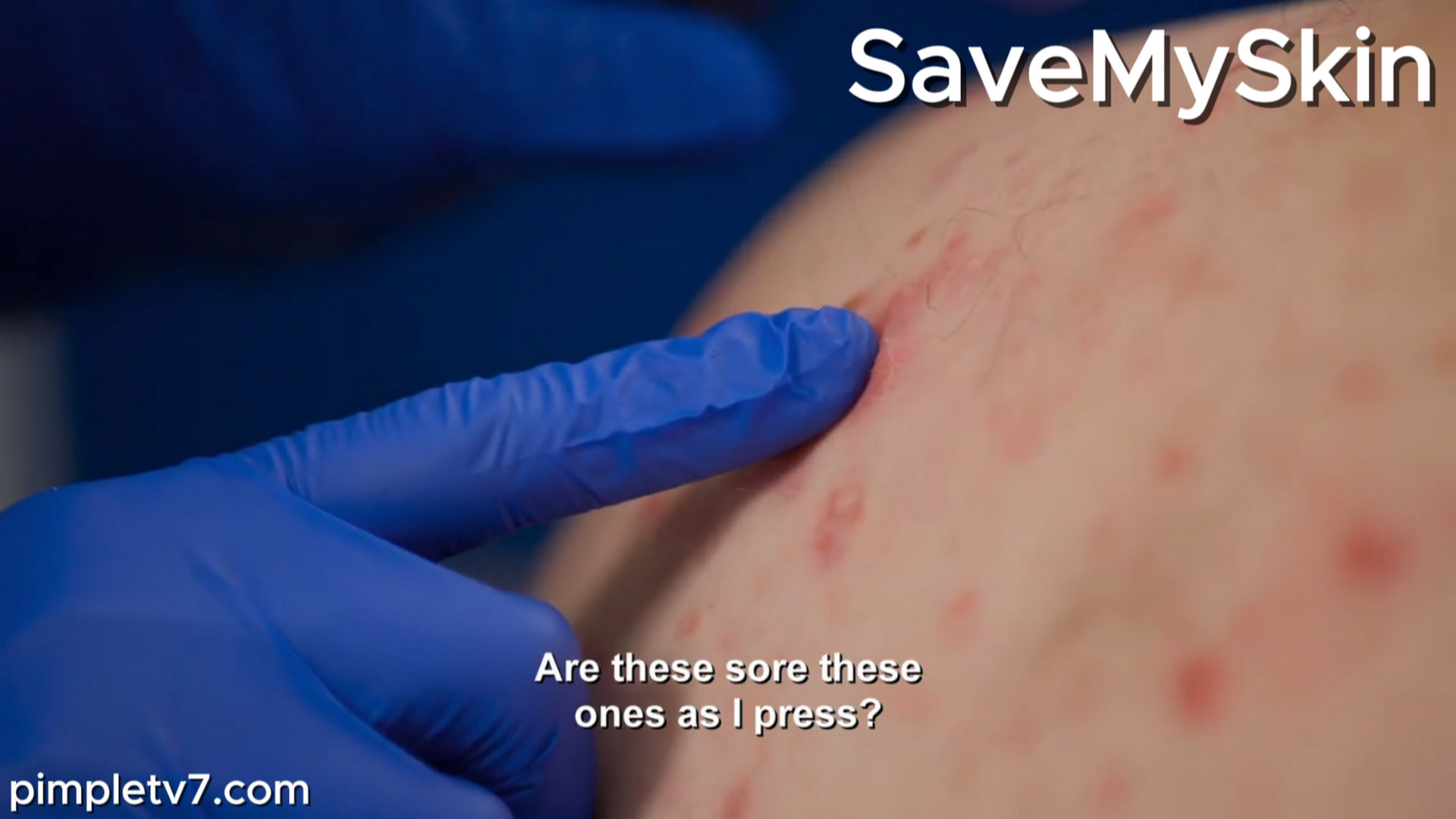 Alfie has severe acne on his chest, shoulders, and back. SaveMySkin 030926