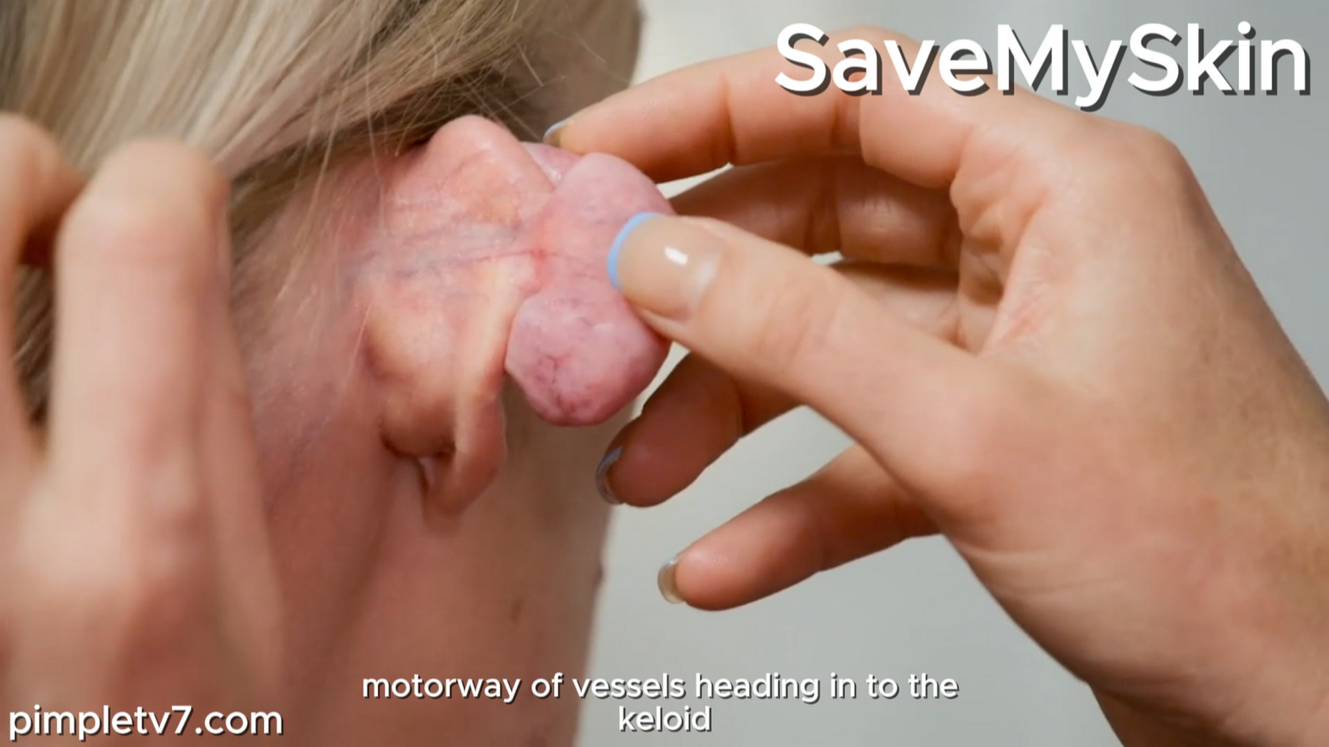 Amber, about her keloid scar on her ear. SaveMySkin 290926
