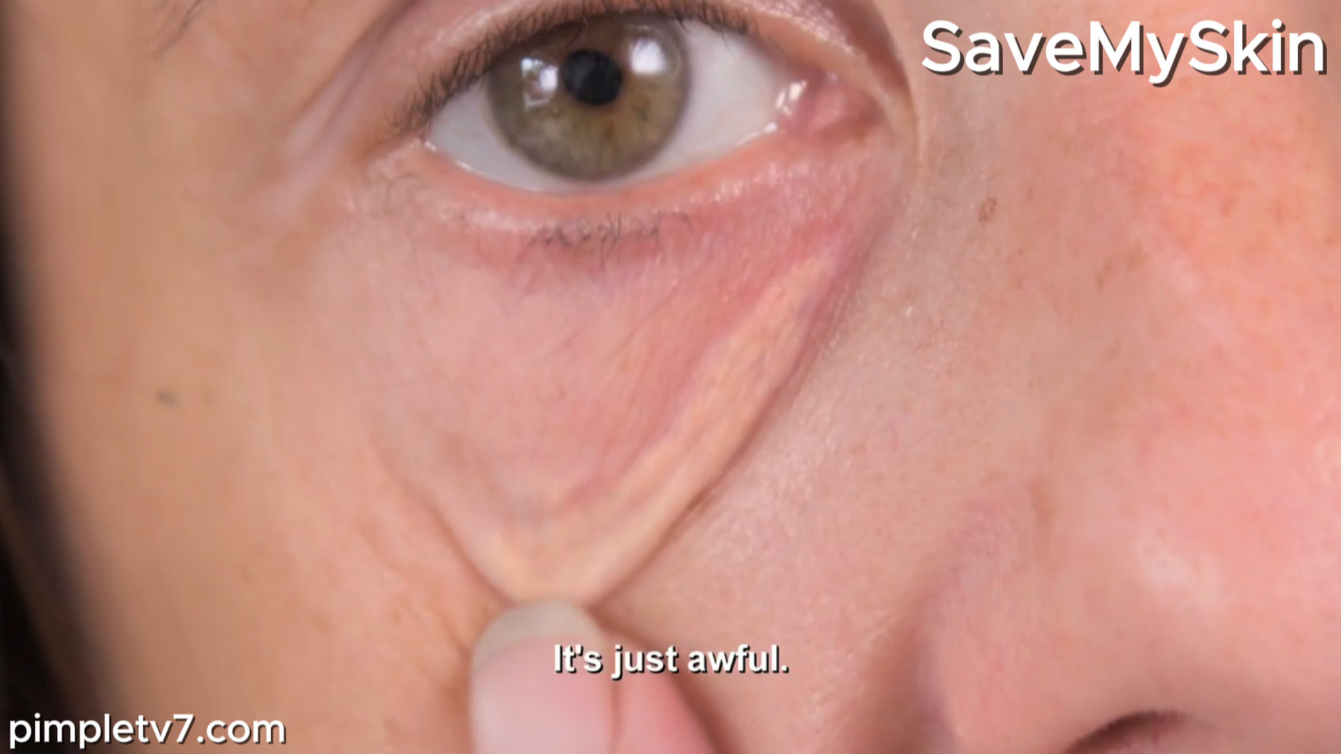 Andrea’s skin growth under her eyes distracts her from work. SaveMySkin 060926