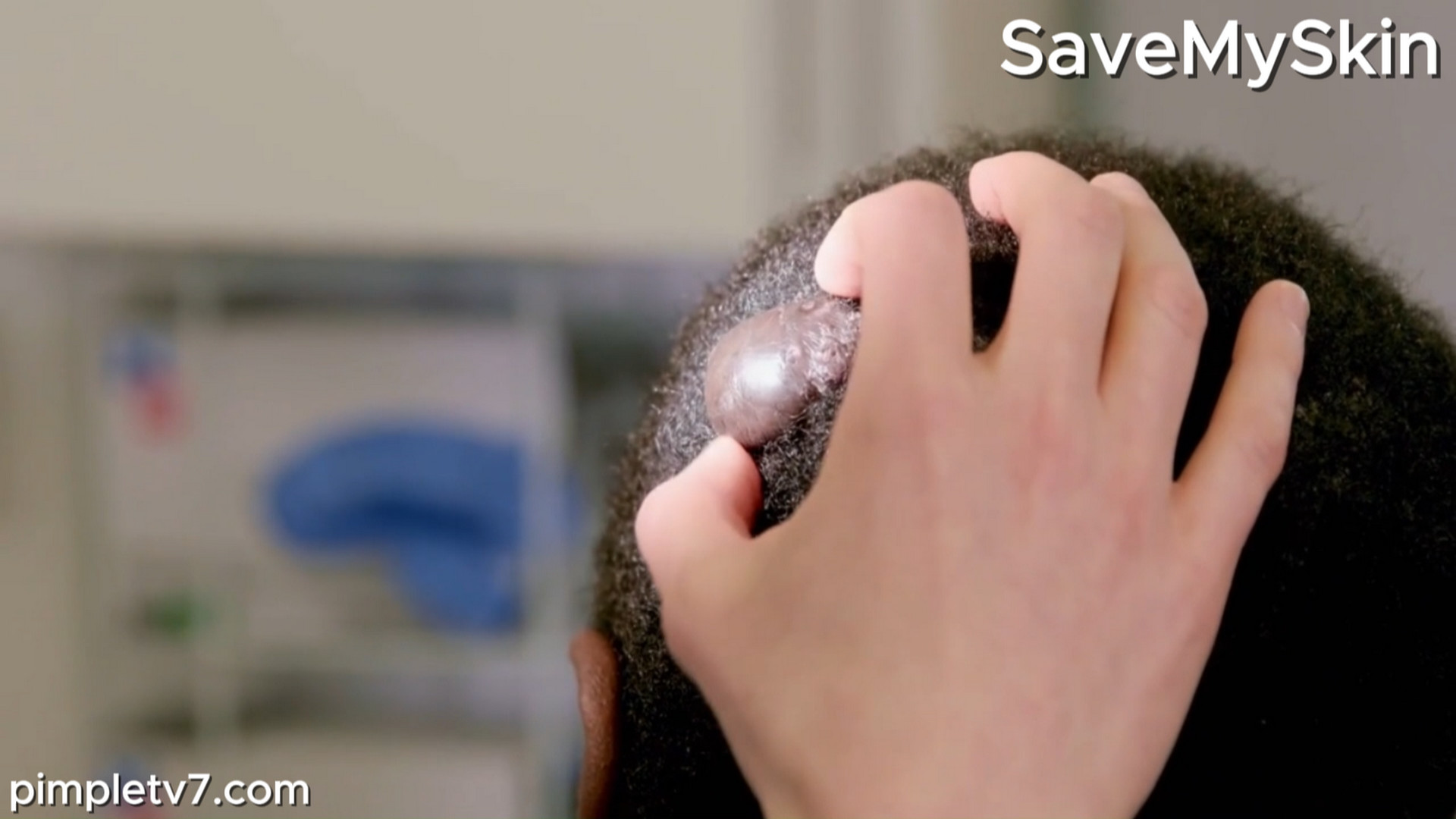 Andrew dreams of finding love, but the bumps on his scalp are turning off the ladies. SaveMySkin 020926