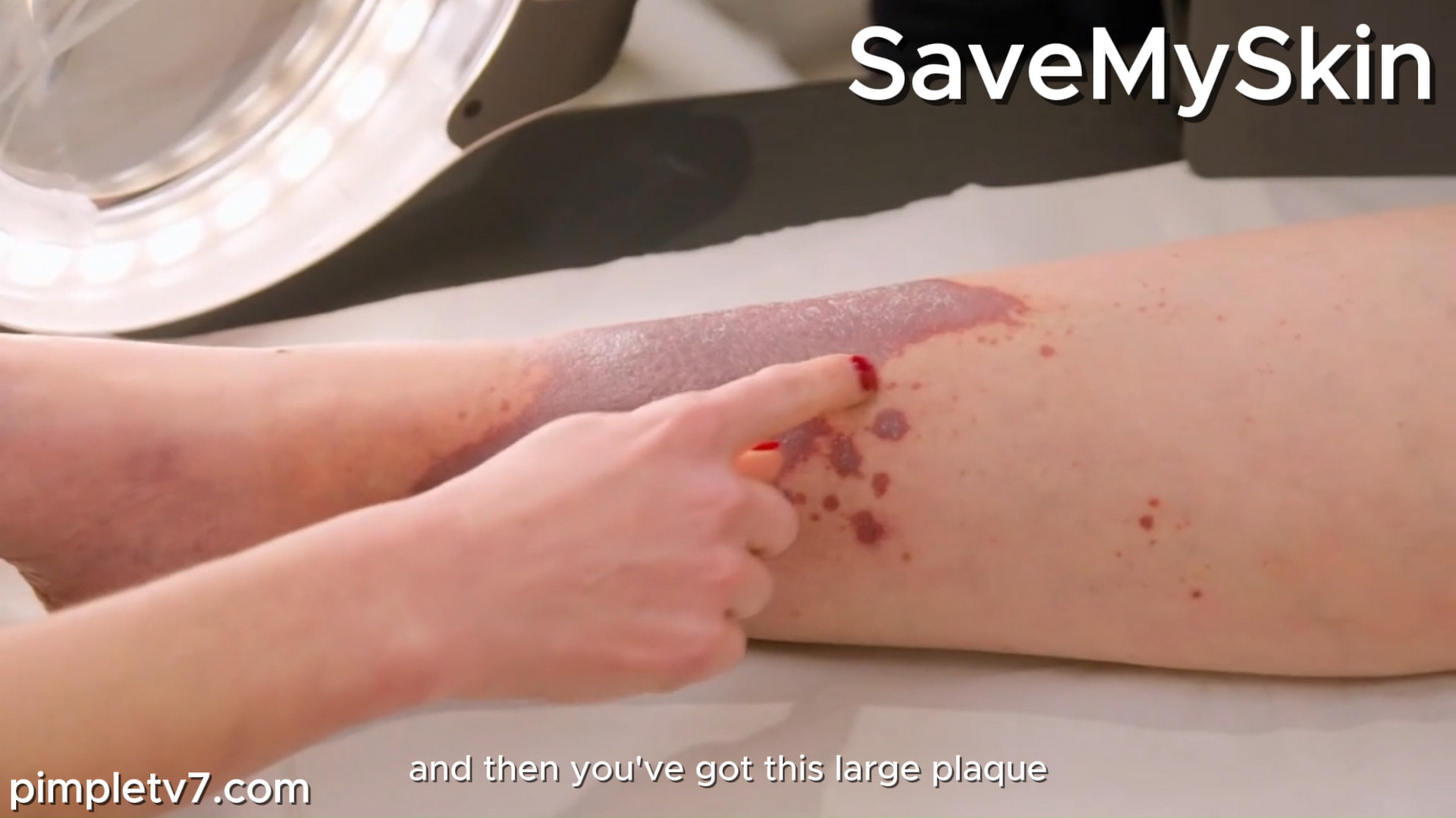 Charlotte’s painful purple patches on her legs have been diagnosed as eczema. SaveMySkin 150926
