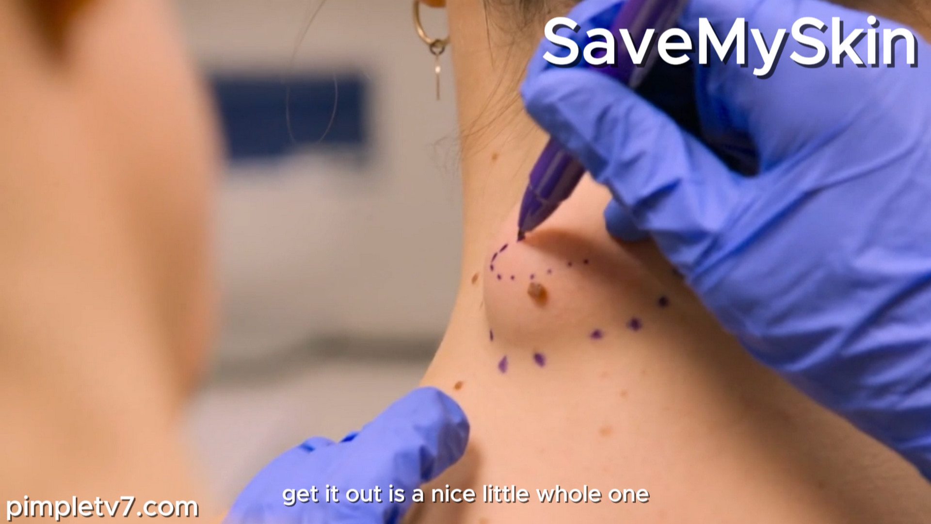 Charnelle, it was just a small blackhead; it started to turn into a lump on her neck around six or seven years ago. SaveMySkin 070926