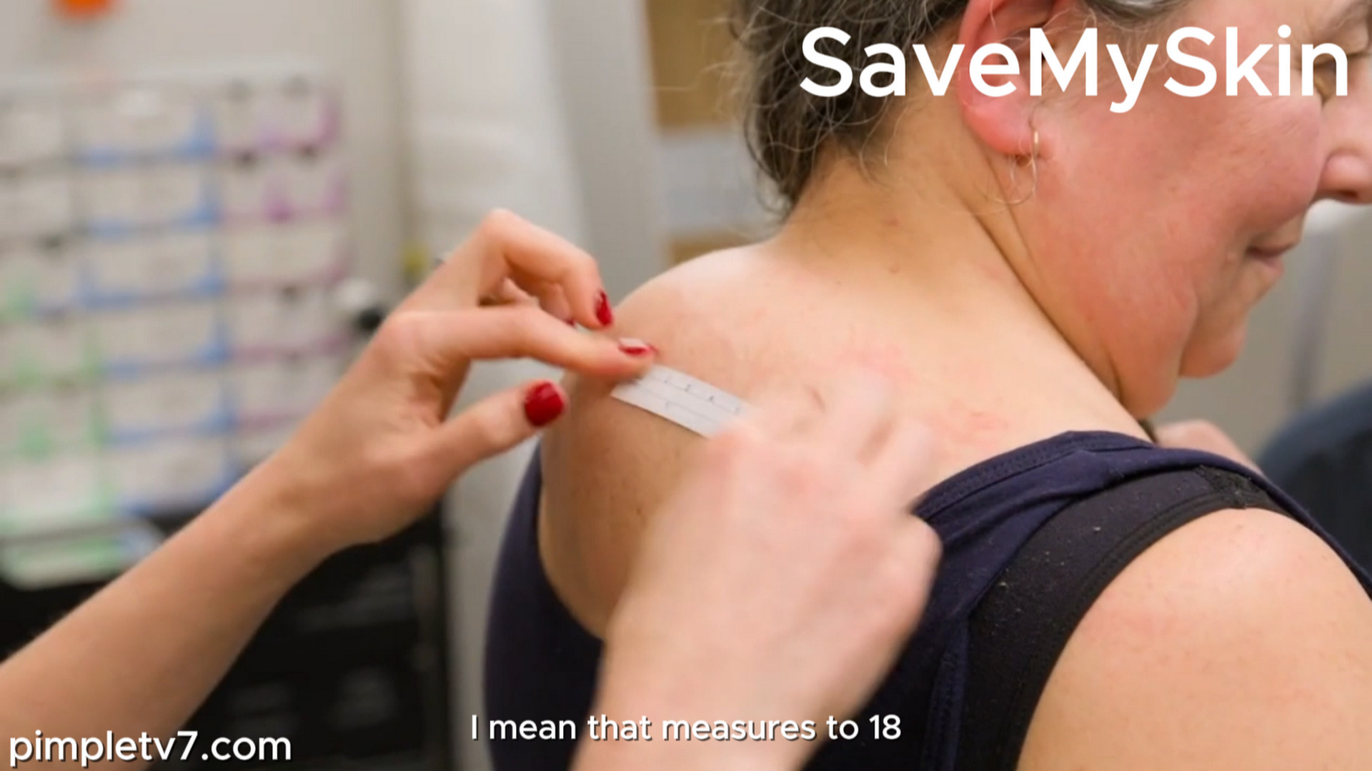 Chrissie had a lipoma removed 14 years ago, but it’s grown back bigger than ever. SaveMySkin 130926