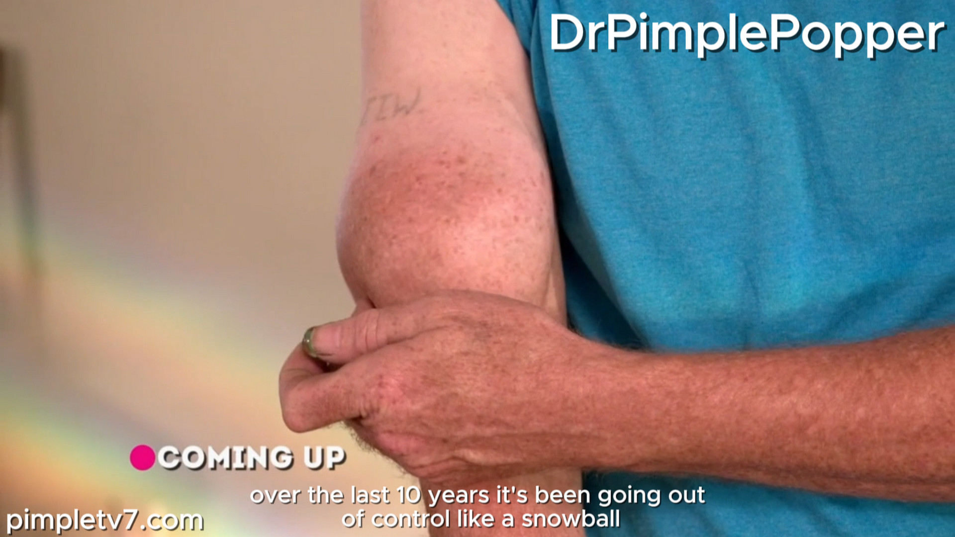 Chuck has a bump on his arm, and teenage brothers have matching lumps. Dr. Pimple Popper 170926